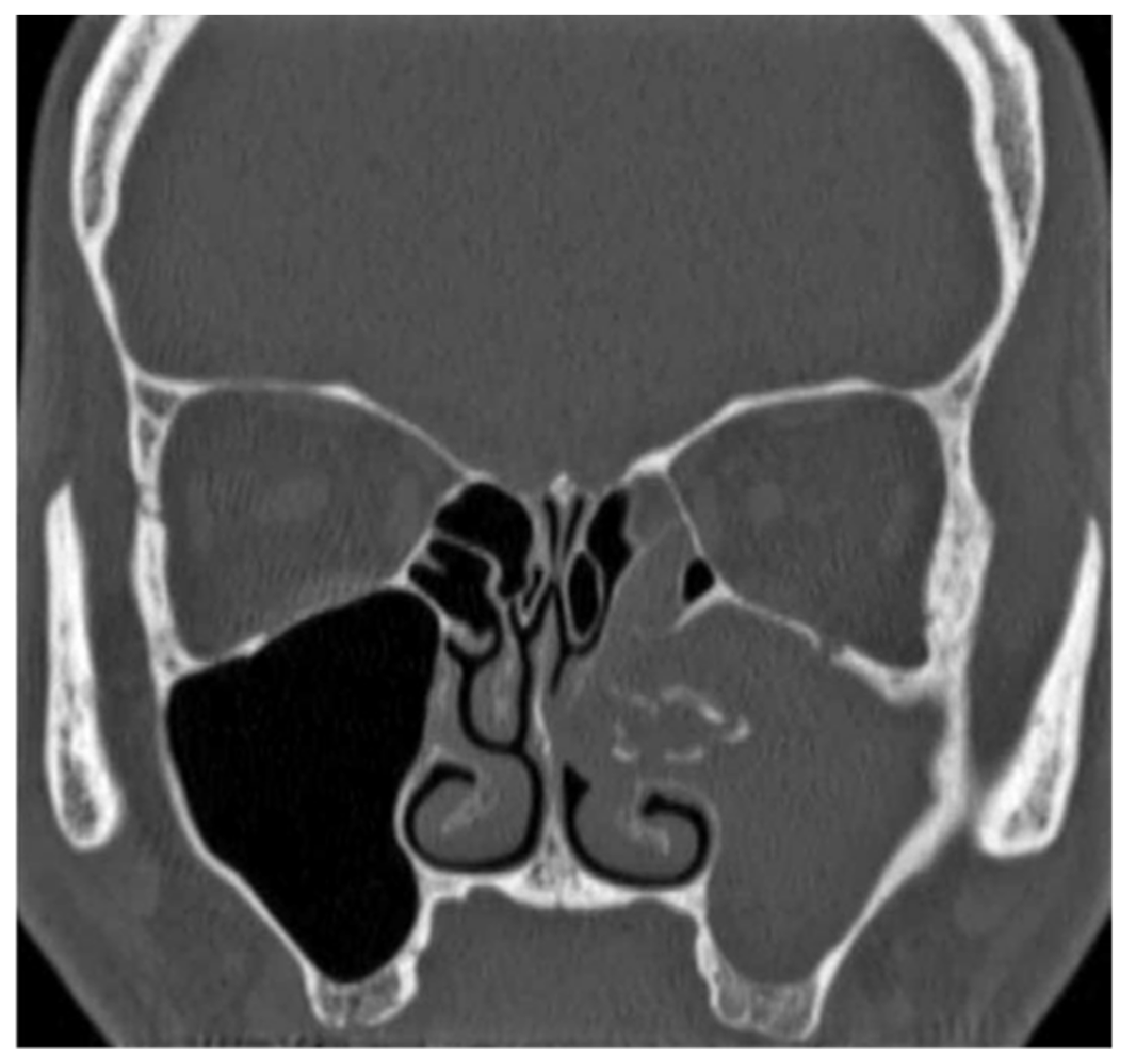 Medicina | Free Full-Text | Prelacrimal Recess Approach in Unilateral ...