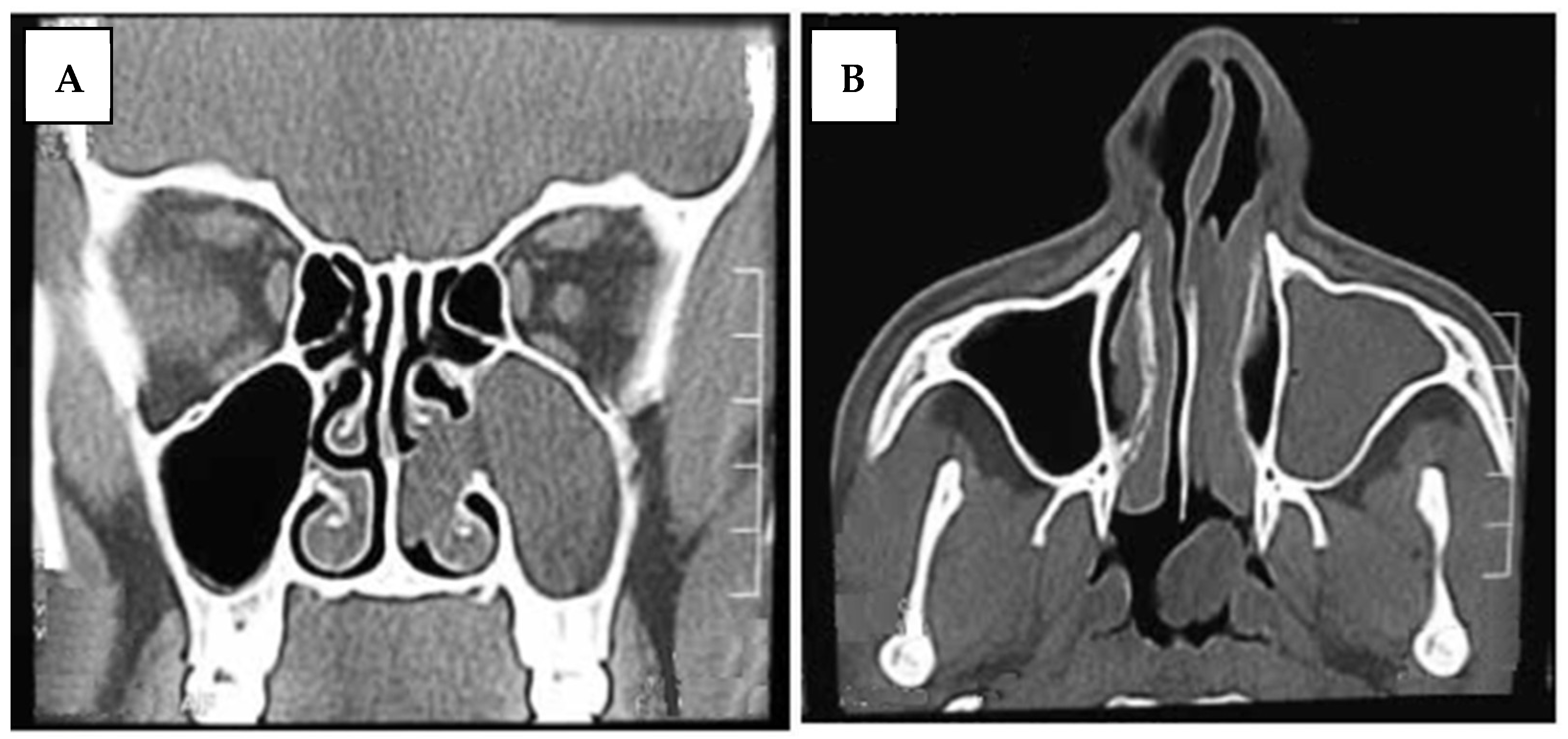 Medicina Free Full Text Prelacrimal Recess Approach In Unilateral Maxillary Sinus Lesions