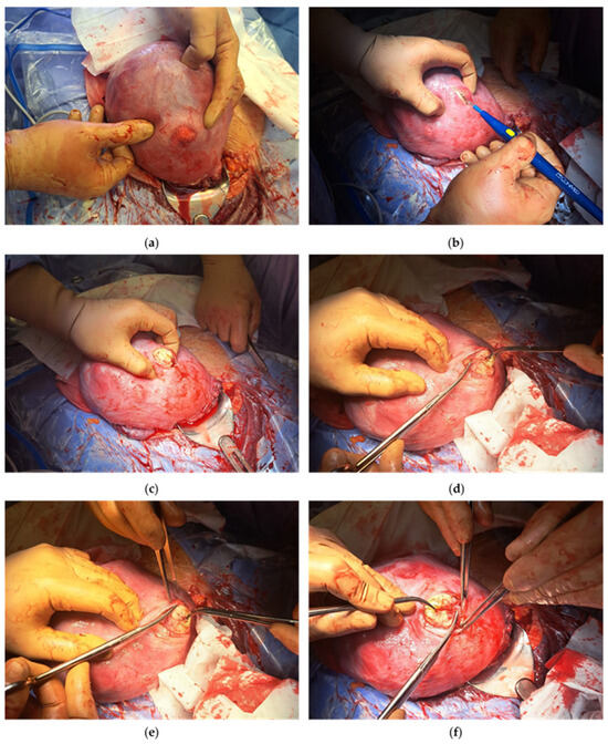 Medicina Free Full Text Cesarean Myomectomy Reflections On