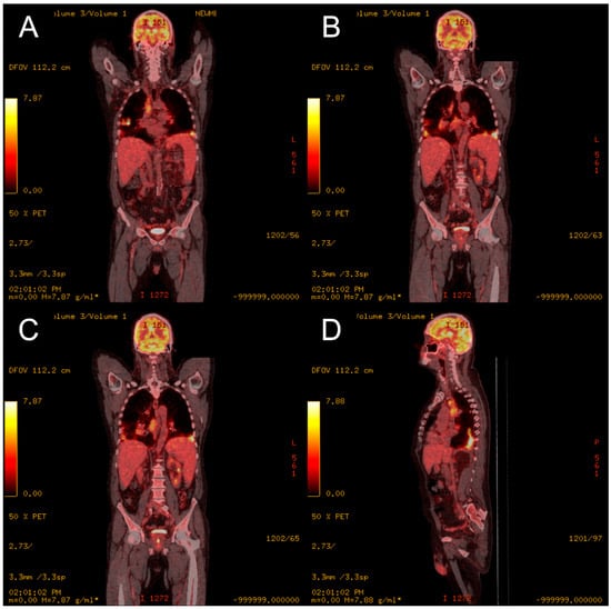 # Unlocking the Secrets of PET CT in Diagnosing Sarcoidosis: A Comprehensive Guide