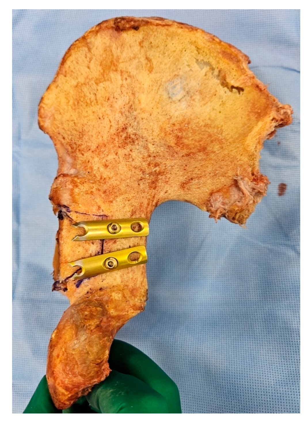 Medicina | Free Full-Text | Biomechanical Comparison of Fixation ...