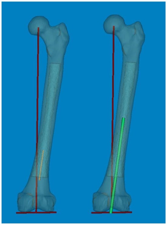 Medicina | Free Full-Text | Three-Dimensional Bowing Measurement of ...