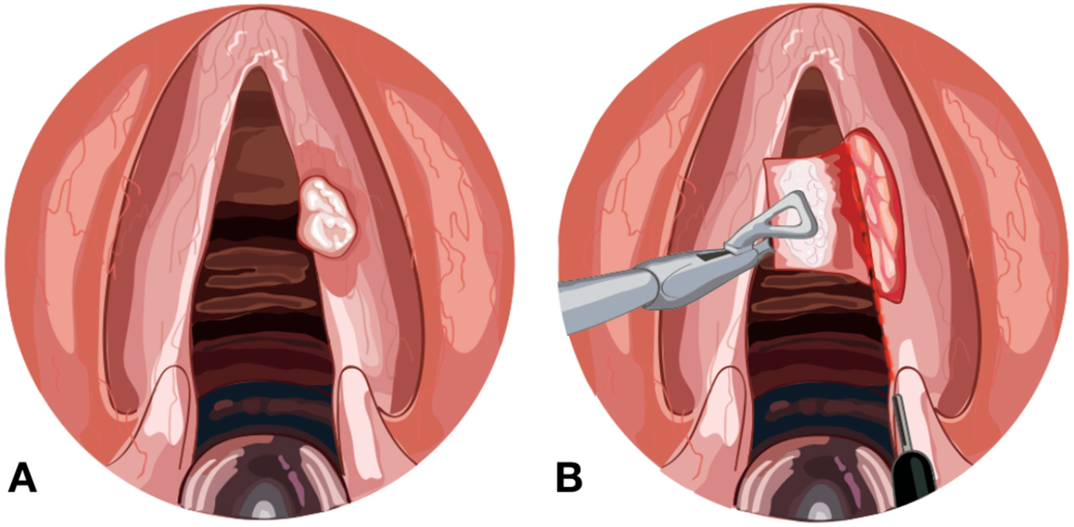 Medicines | Free Full-Text | CO2 Transoral Laser Microsurgery in Benign,  Premalignant and Malignant (Tis, T1, T2) Lesion of the Glottis. A  Literature Review