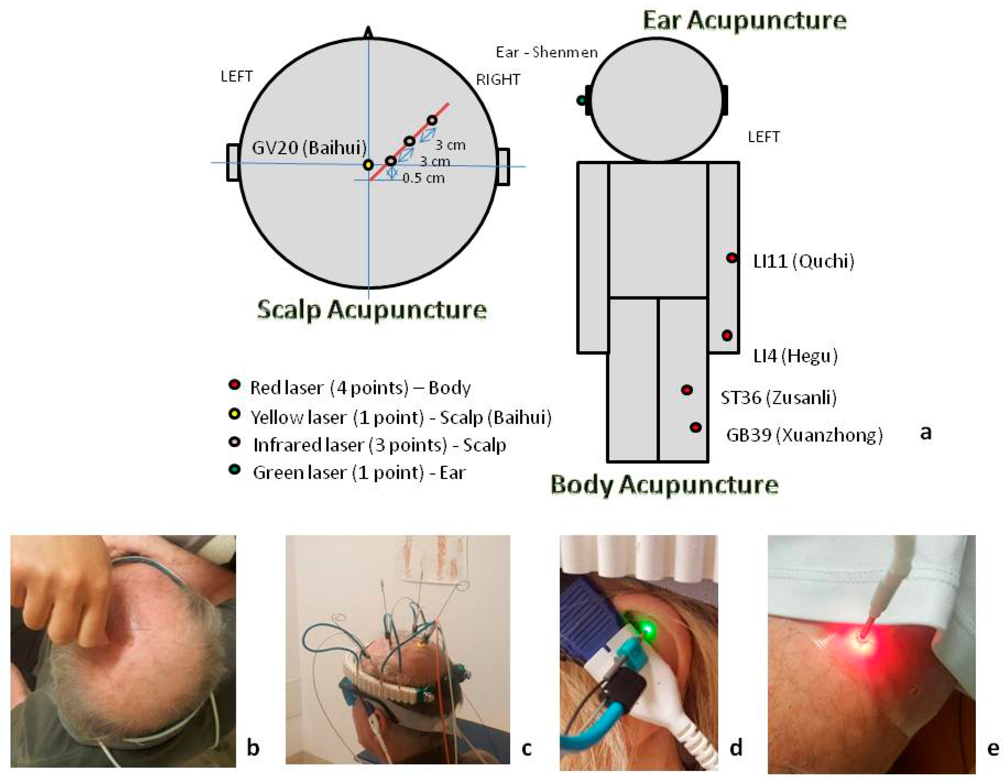 Medicines | Free Full-Text | Multimodal Laser Stimulation and Traditional  Needle Acupuncture in Post-Stroke Patients—A Pilot Cross-Over Study with  Results from Near Infrared Spectroscopy