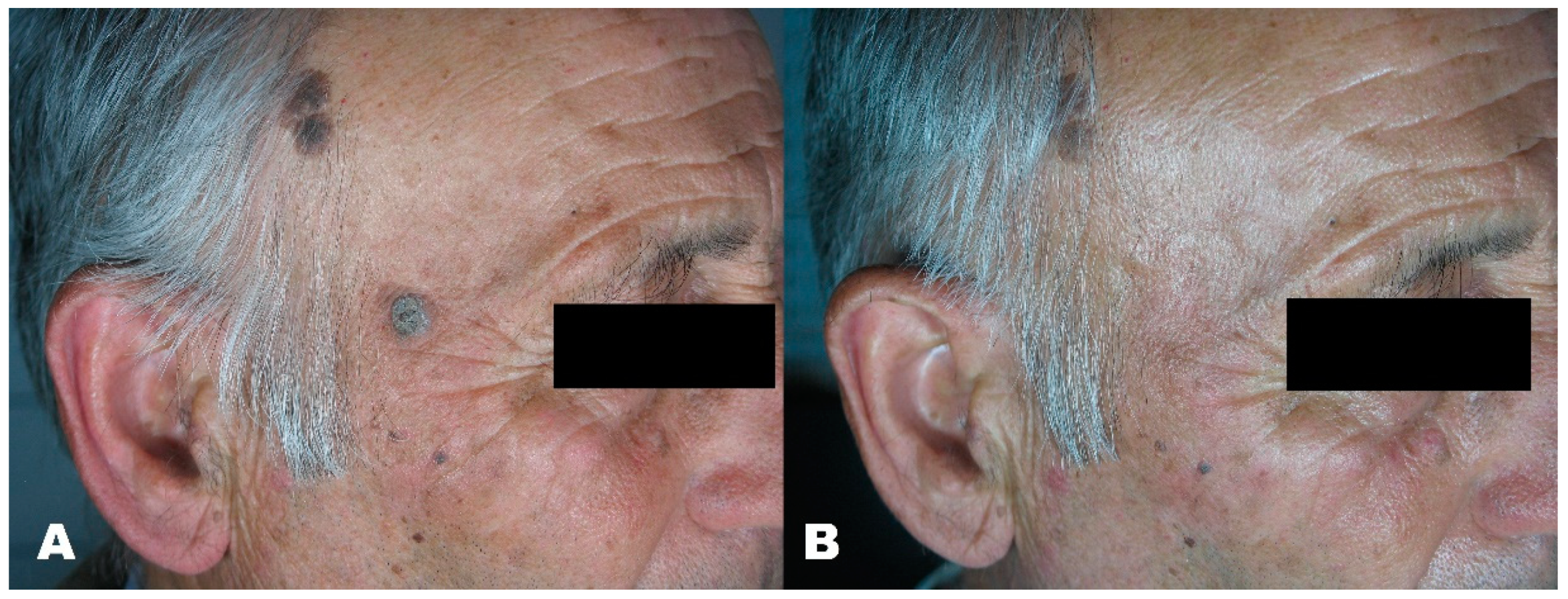 Medicines | Free Full-Text | Erbium Laser for Skin Surgery: A Single-Center  Twenty-Five Years&rsquo; Experience