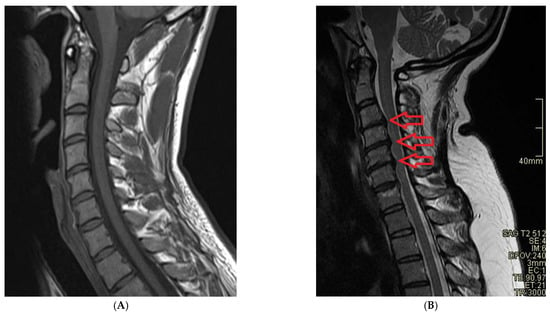 Typical cervical vertebrae  Radiology Reference Article