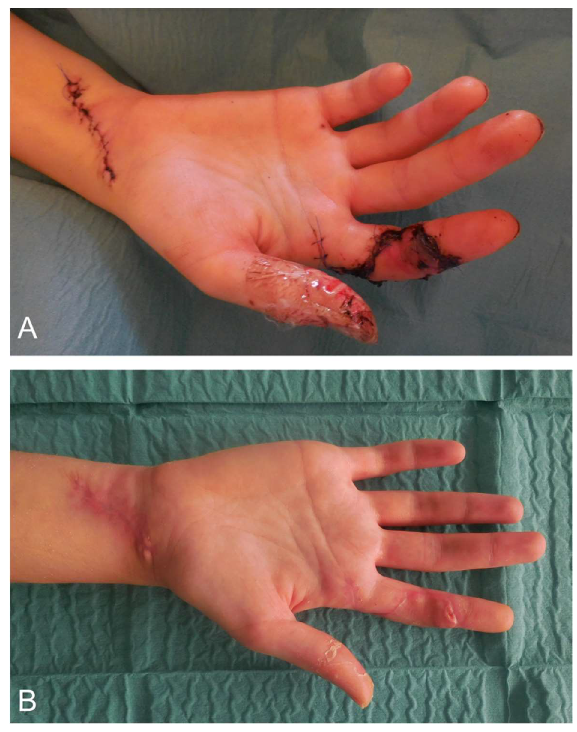 a) Crush injury to the right leg and foot region; (b) soft tissue