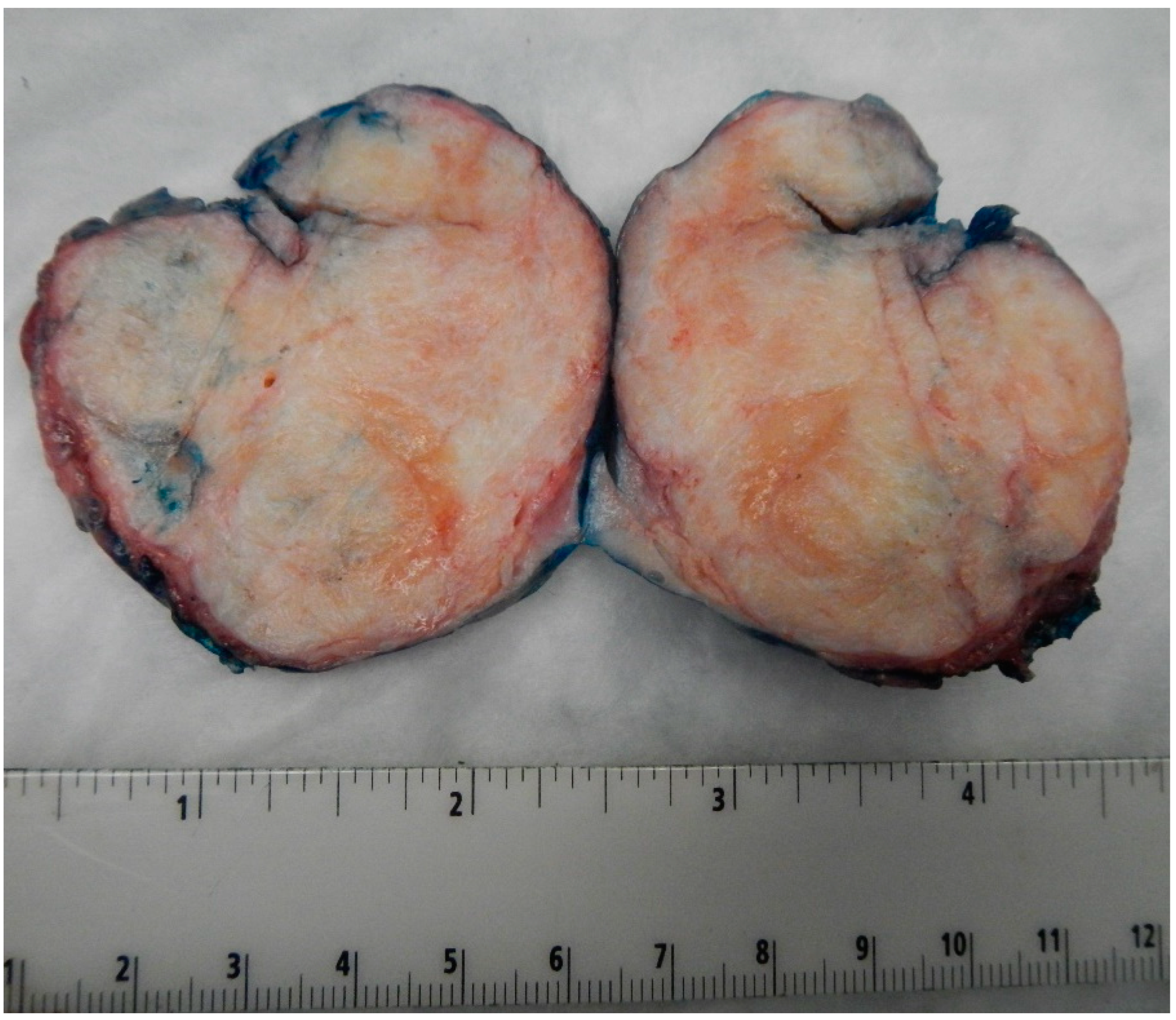 Medical Sciences | Free Full-Text | Brenner Tumor of the Ovary: A 10-Year  Single Institution Experience and Comprehensive Review of the Literature