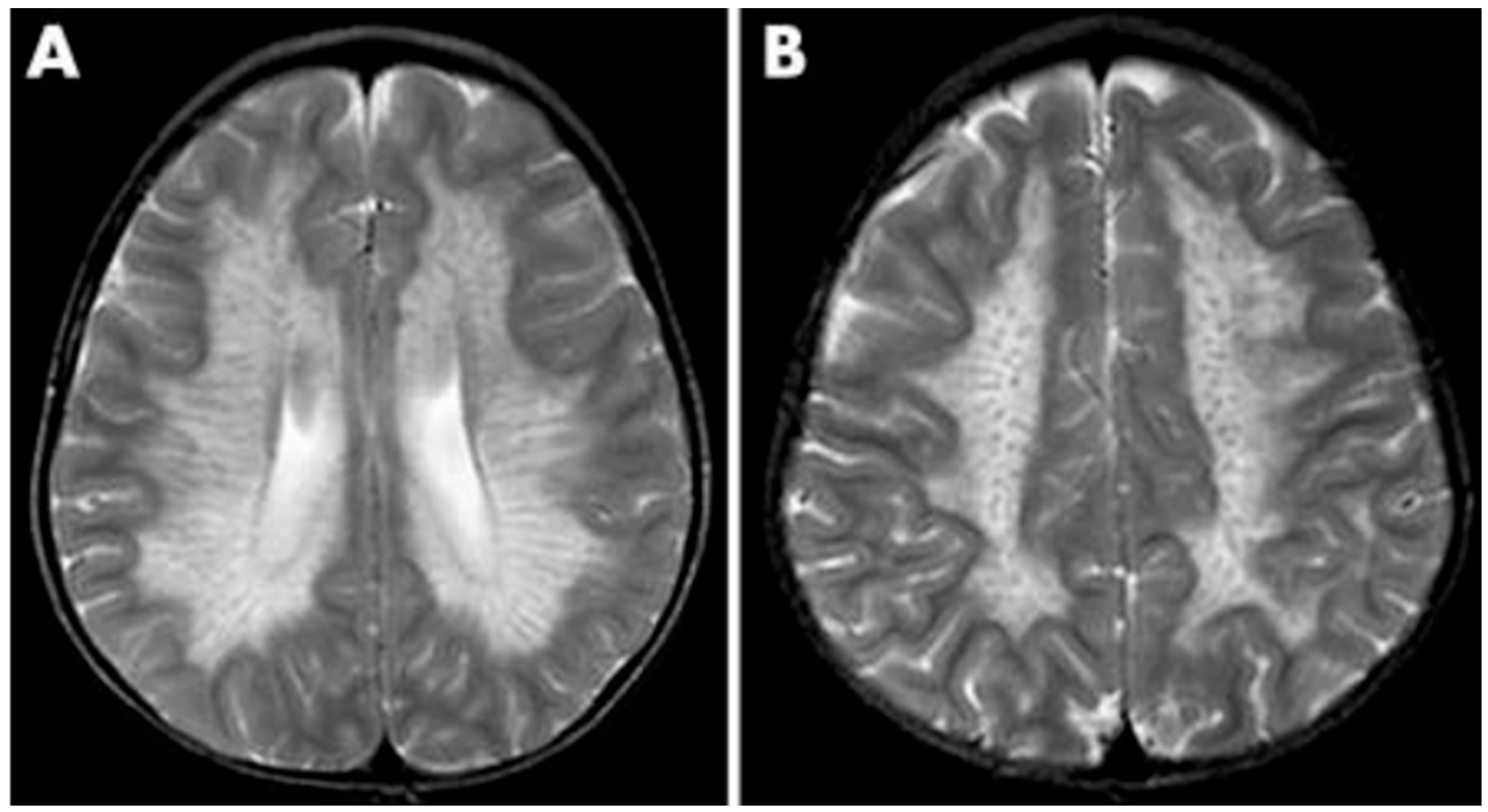 Medical Sciences | Free Full-Text | Leukodystrophy Imaging: Insights ...