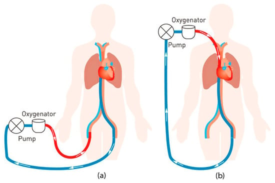 extracorporeal membrane oxygenation