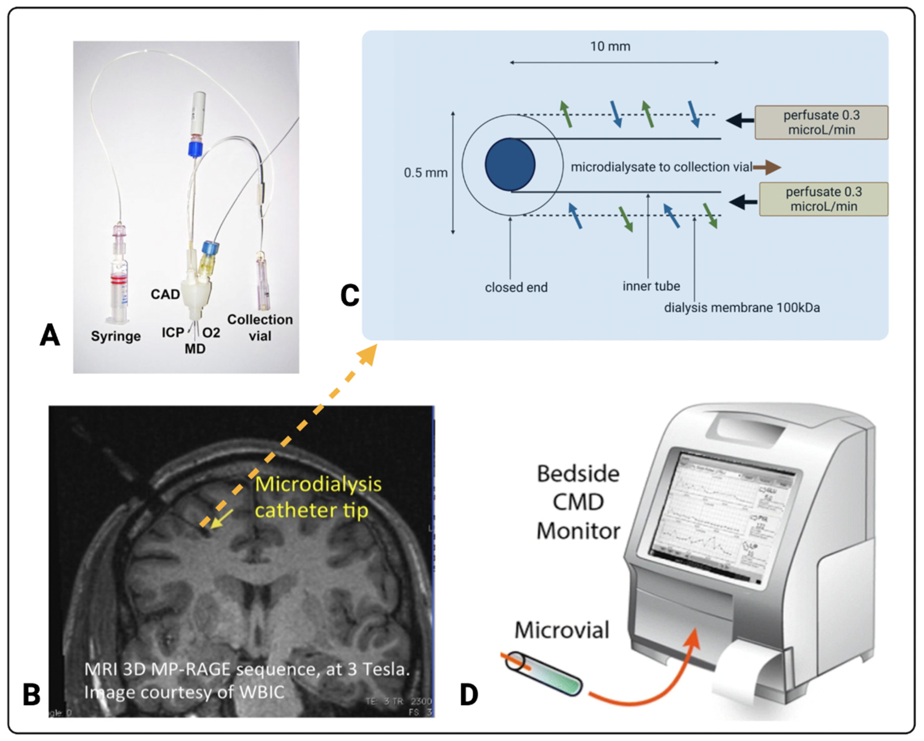 Validation of Dexamethasone-Enhanced Continuous-Online Microdialysis for  Monitoring Glucose for 10 Days after Brain Injury