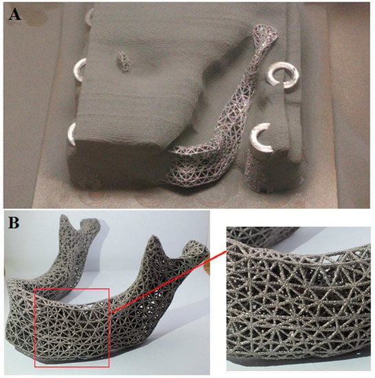 Example of titanium mesh (A) that can easily conform to the contours of