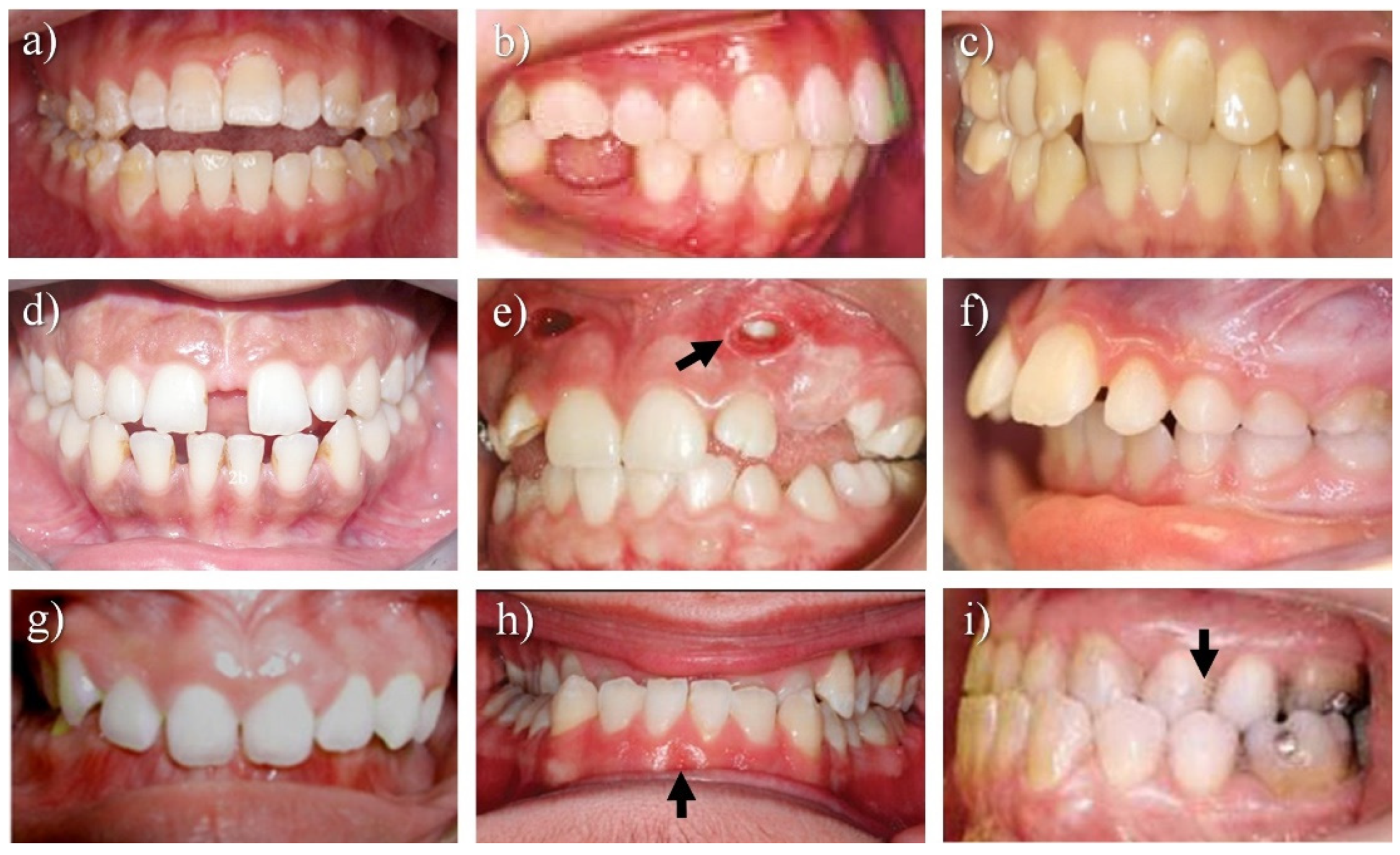 Metal Braces - Peninsula Orthodontics