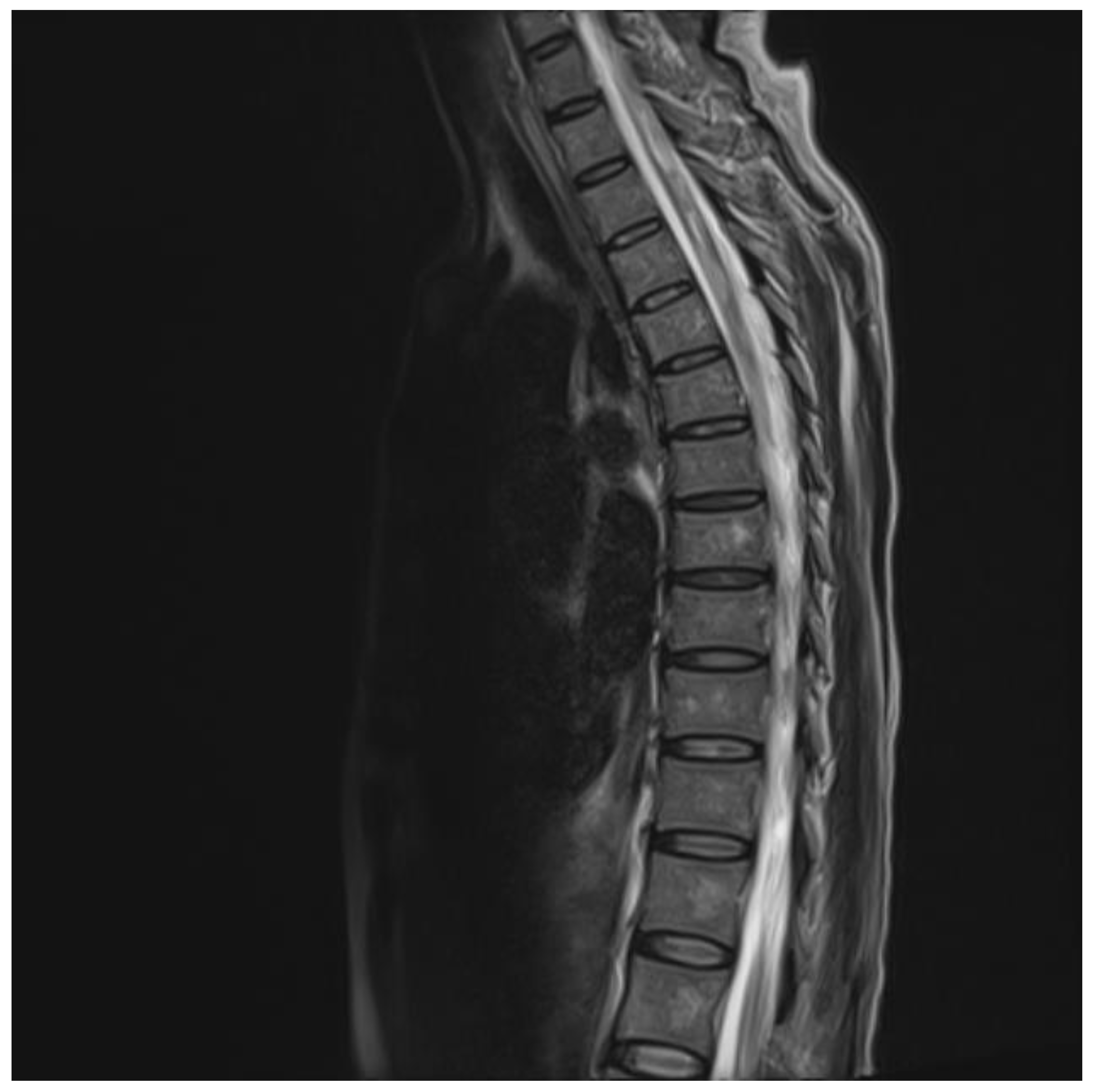 Microbiology Research | Free Full-Text | Longitudinally Extensive  Transverse Myelitis Associated with Cytomegalovirus Infection in an  Immunocompetent Patient