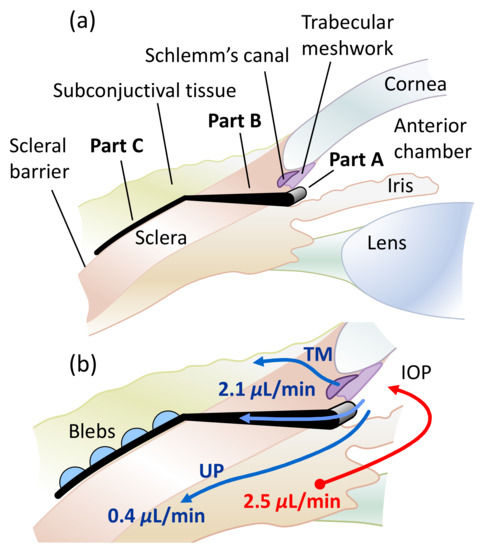 Micromachines | Free Full-Text | Rational Design of Microfluidic Glaucoma  Stent