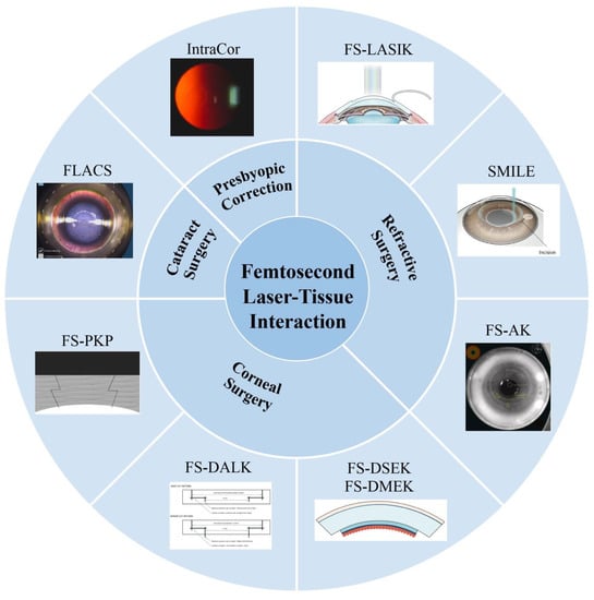 Micromachines | Free Full-Text | Femtosecond Laser-Assisted Ophthalmic  Surgery: From Laser Fundamentals to Clinical Applications | HTML