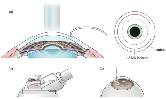 laser assisted in situ keratomileusis