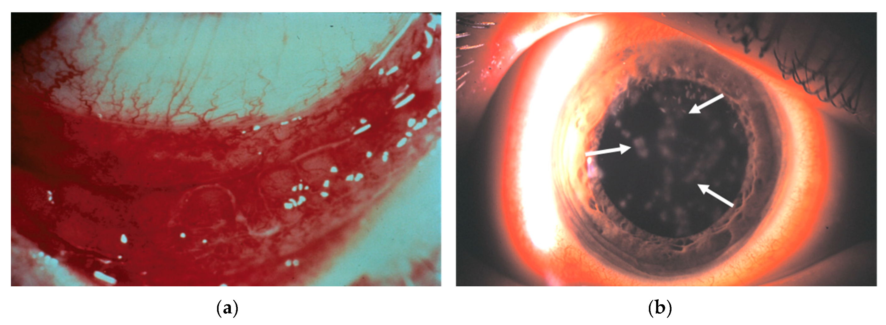 adenoviral keratitis