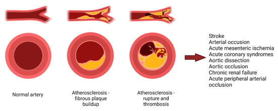 Atherosclerotic plaque in arteries overview • Heart Research Institute
