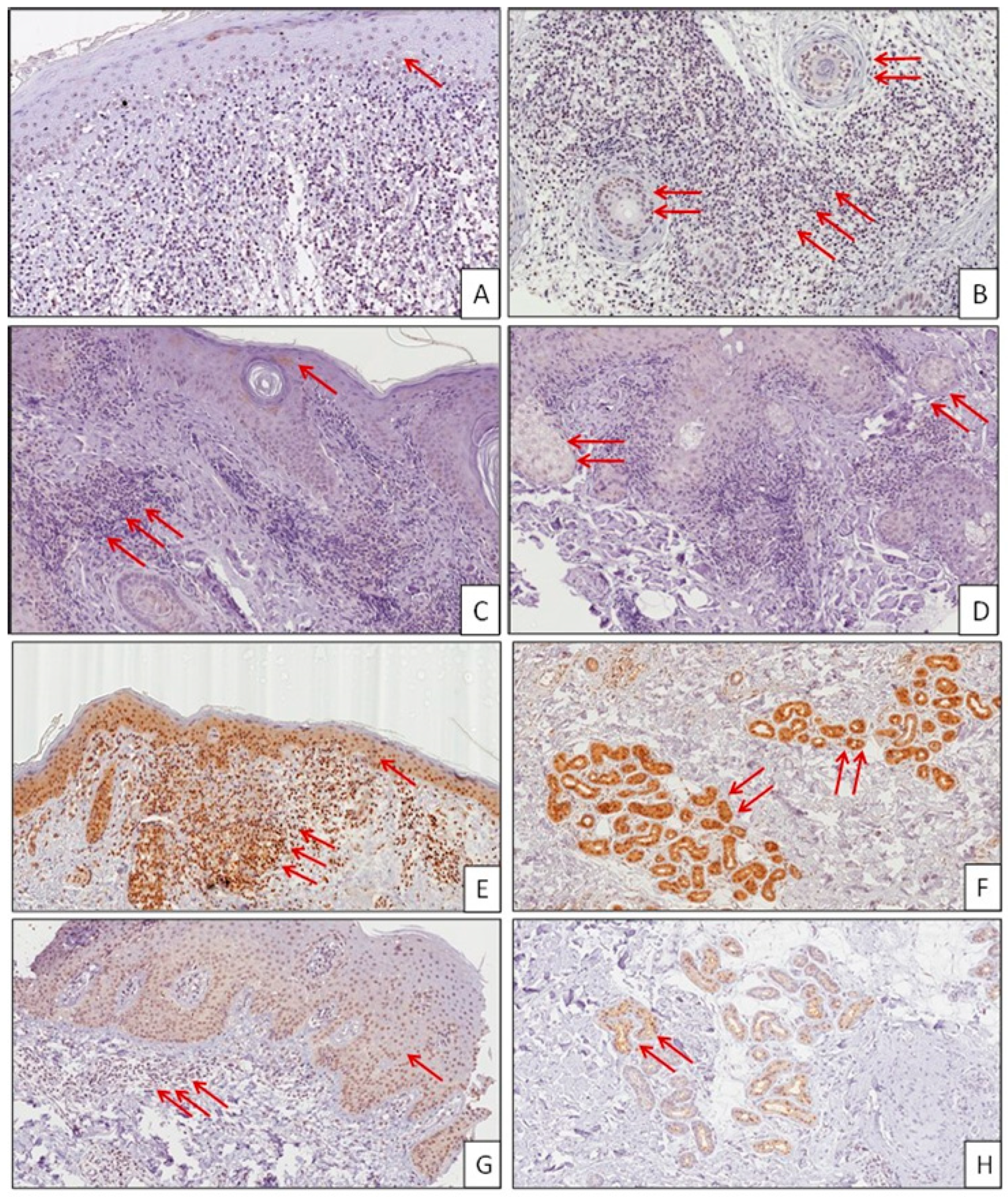 Molecules Free Full-Text Macrophage Migration Inhibitory Factor (MIF) and Its Homologue D-Dopachrome Tautomerase (DDT) Inversely Correlate with Inflammation in Discoid Lupus Erythematosus photo