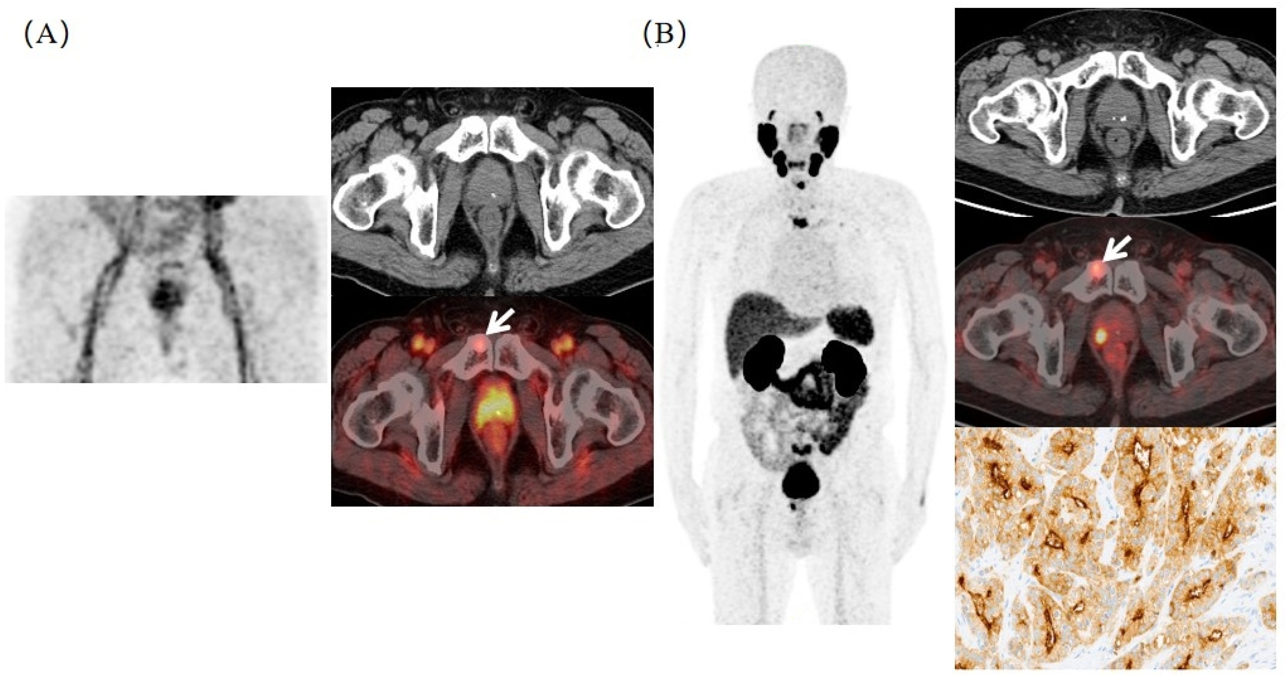 Super Early Scan Of PSMA PET/CT In Evaluating Primary And Metastatic ...