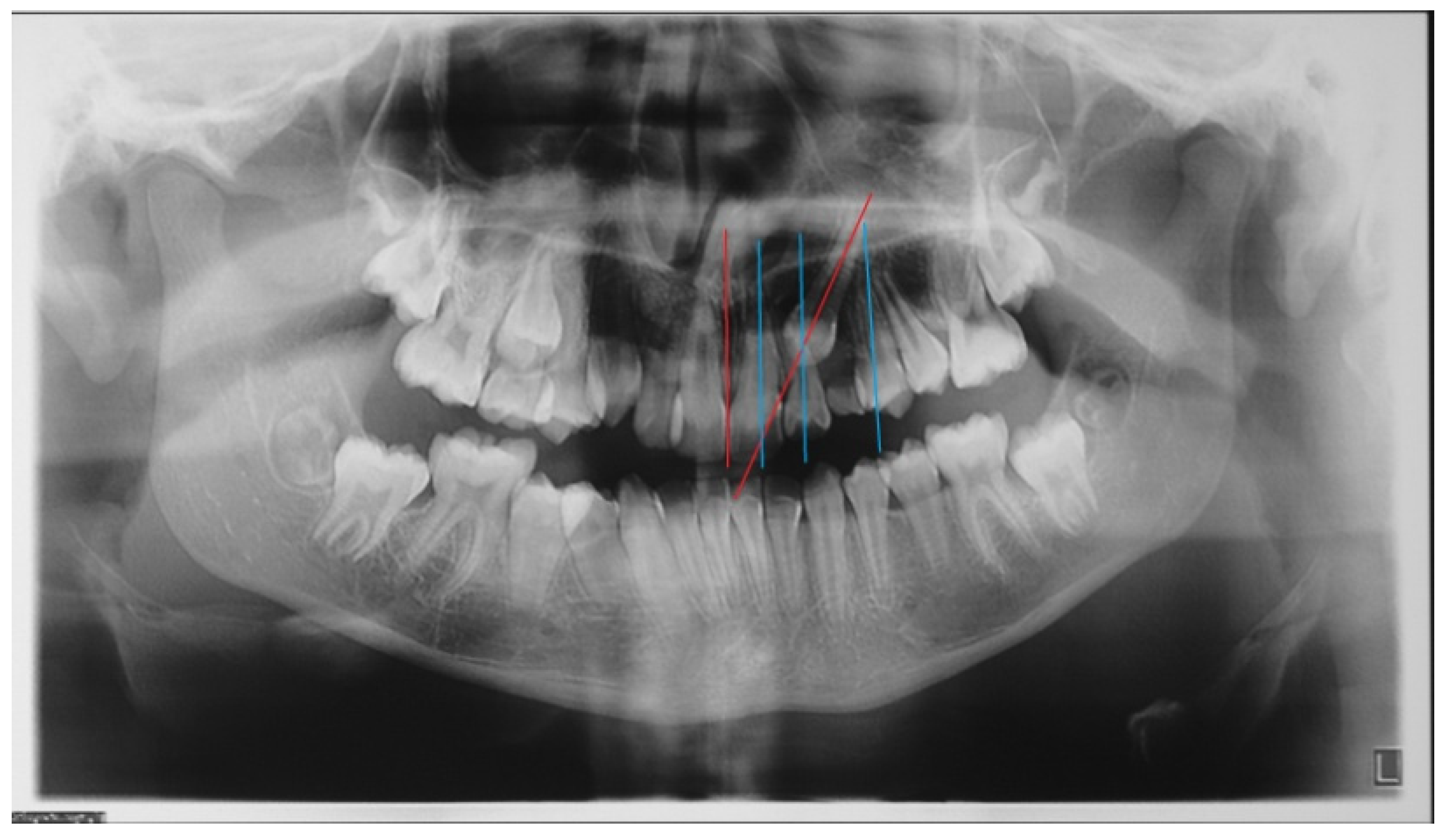 MPs | Free Full-Text | The VISTA Approach in Canine Disimpaction