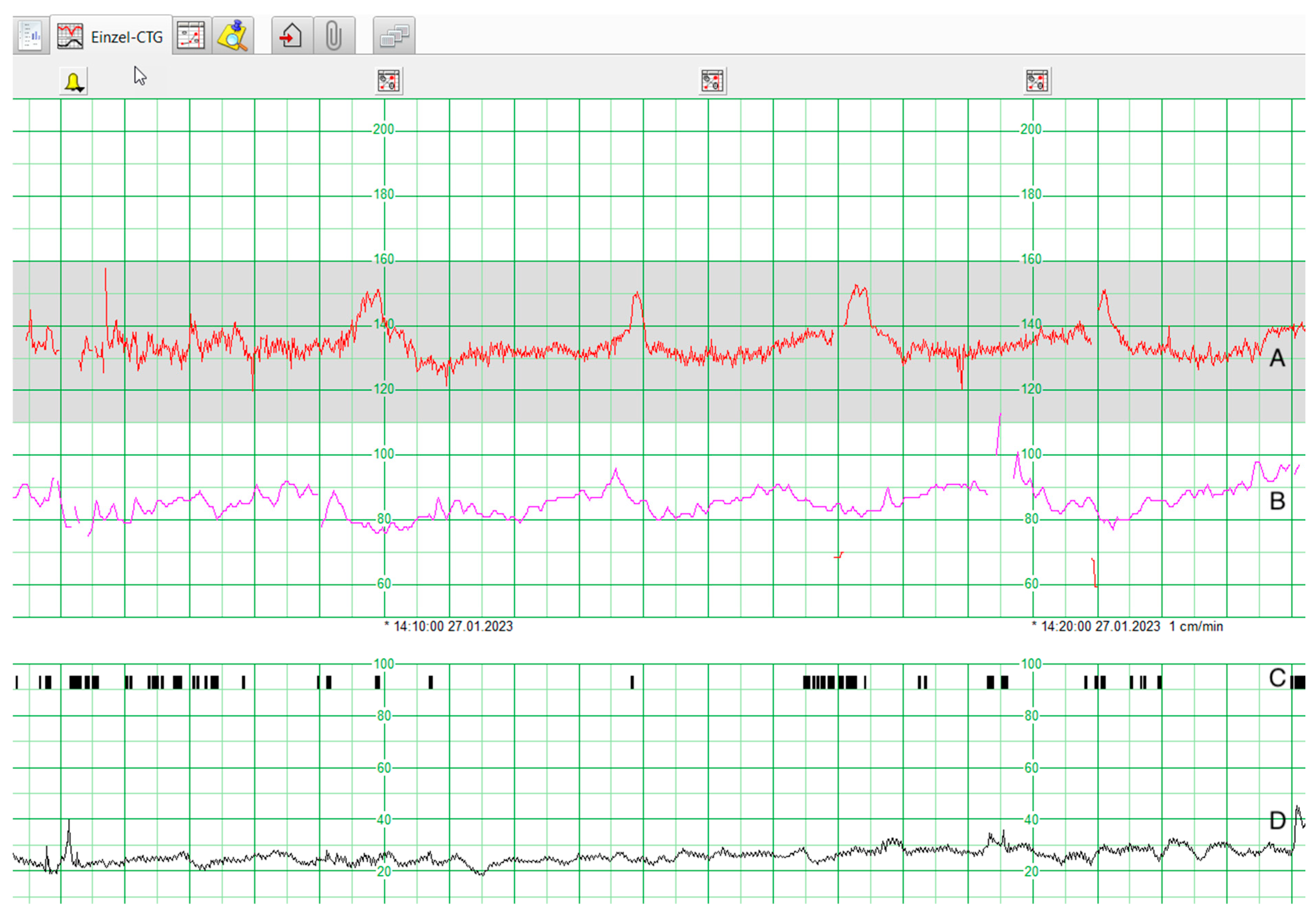 Le CTG (cardiotocographe) - LetsFamily