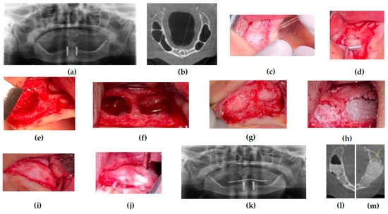 Medical Sciences Forum | Free Full-Text | External Approach to Bilaterally  Septated Maxillary Sinuses: A Case Report
