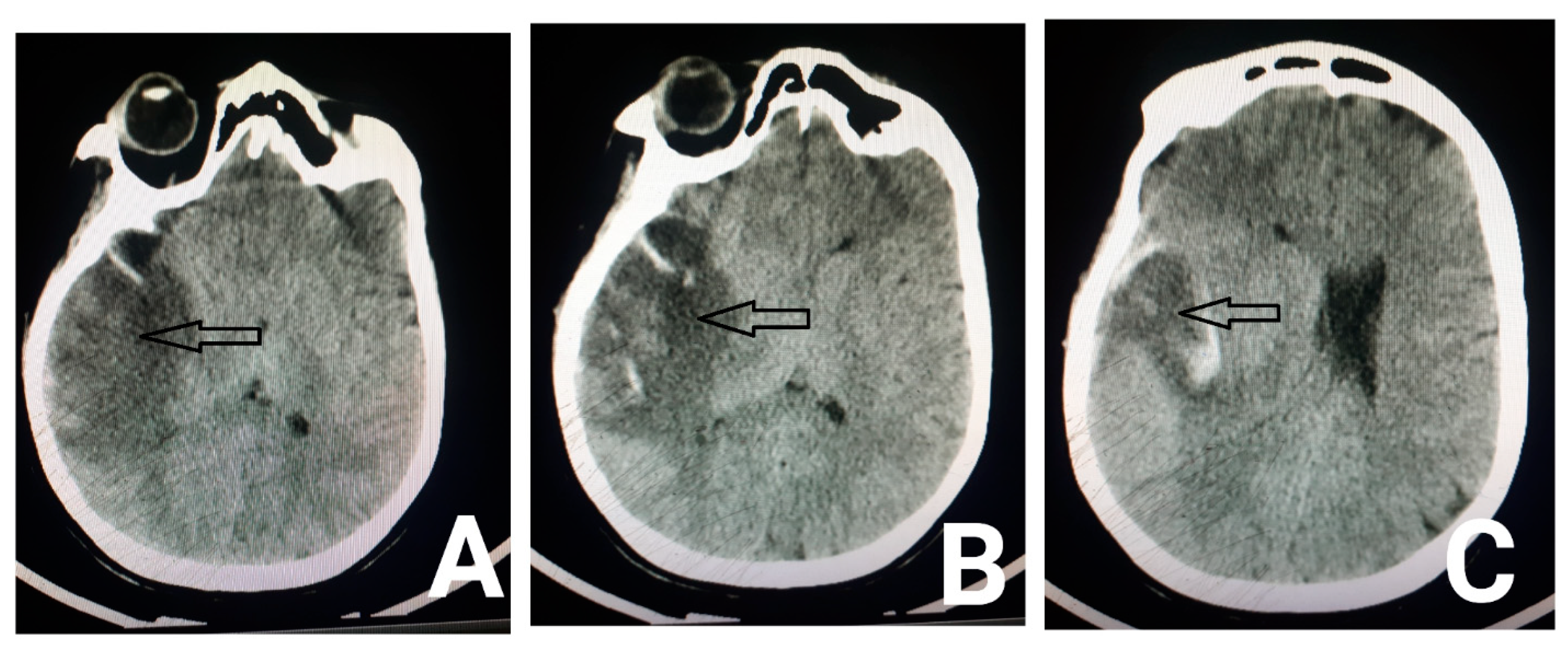 cortical vein thrombosis