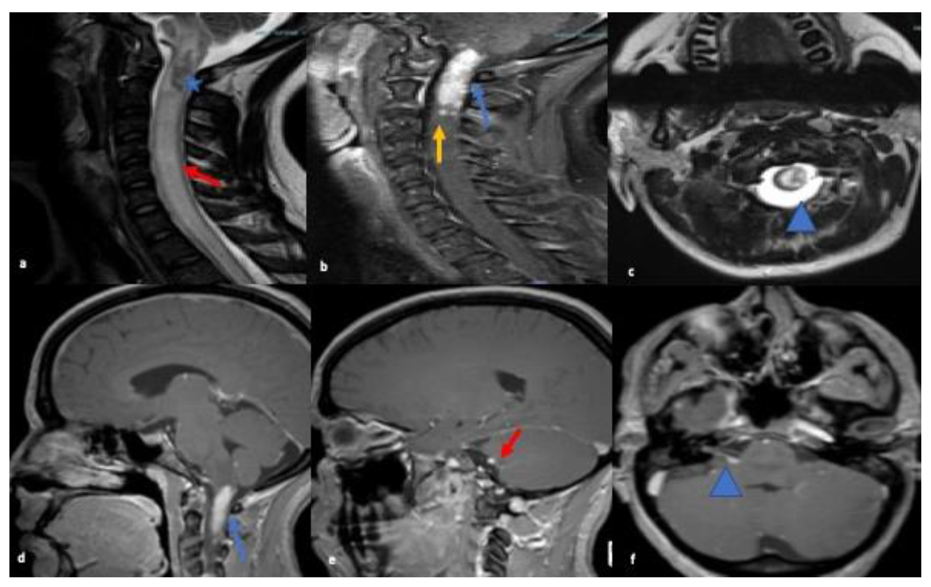 Neurology International | Free Full-Text | Overcoming the