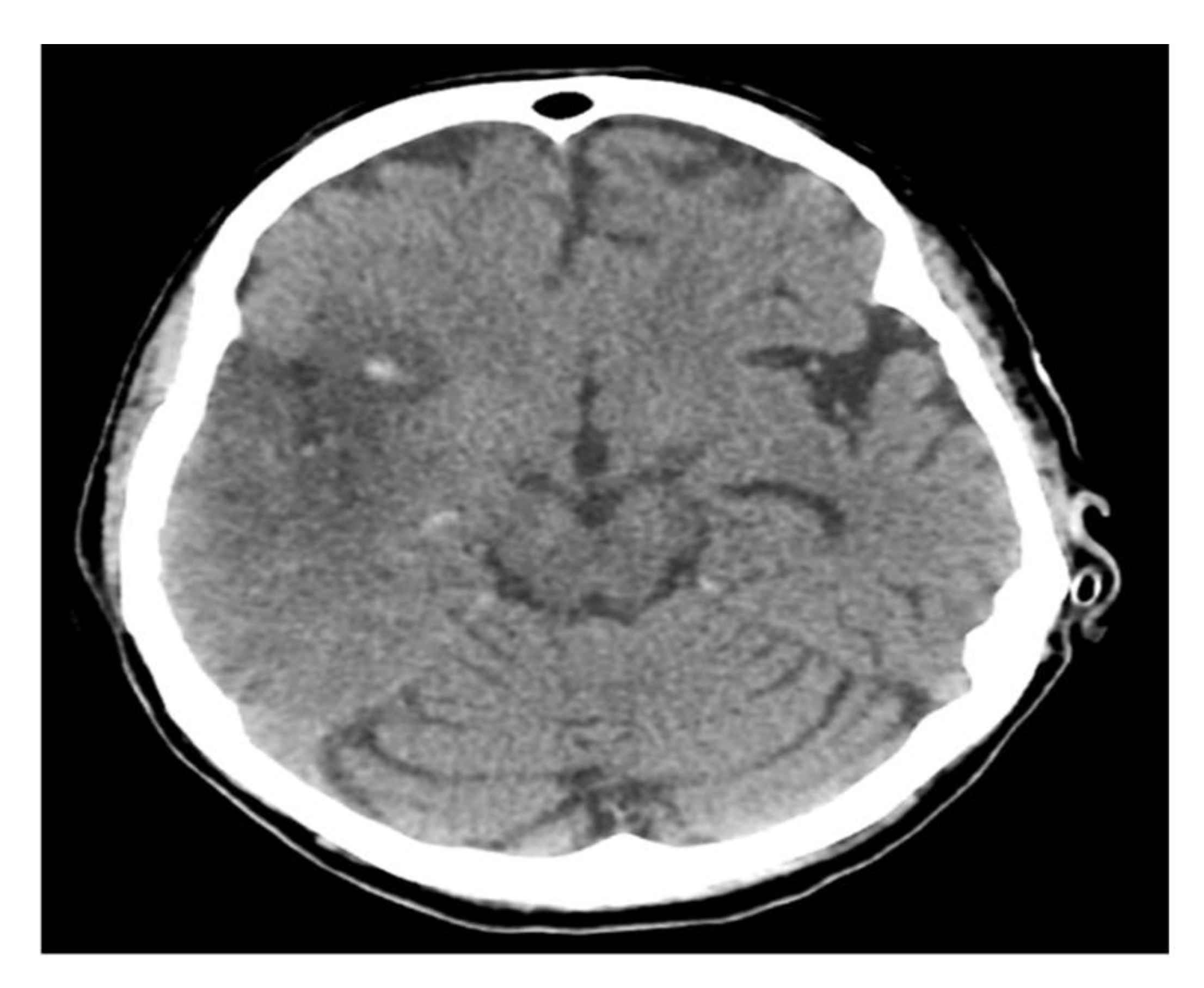 Neurology International Free Full Text Fulminant Guillain Barre Syndrome Post Hemorrhagic Stroke Two Case Reports