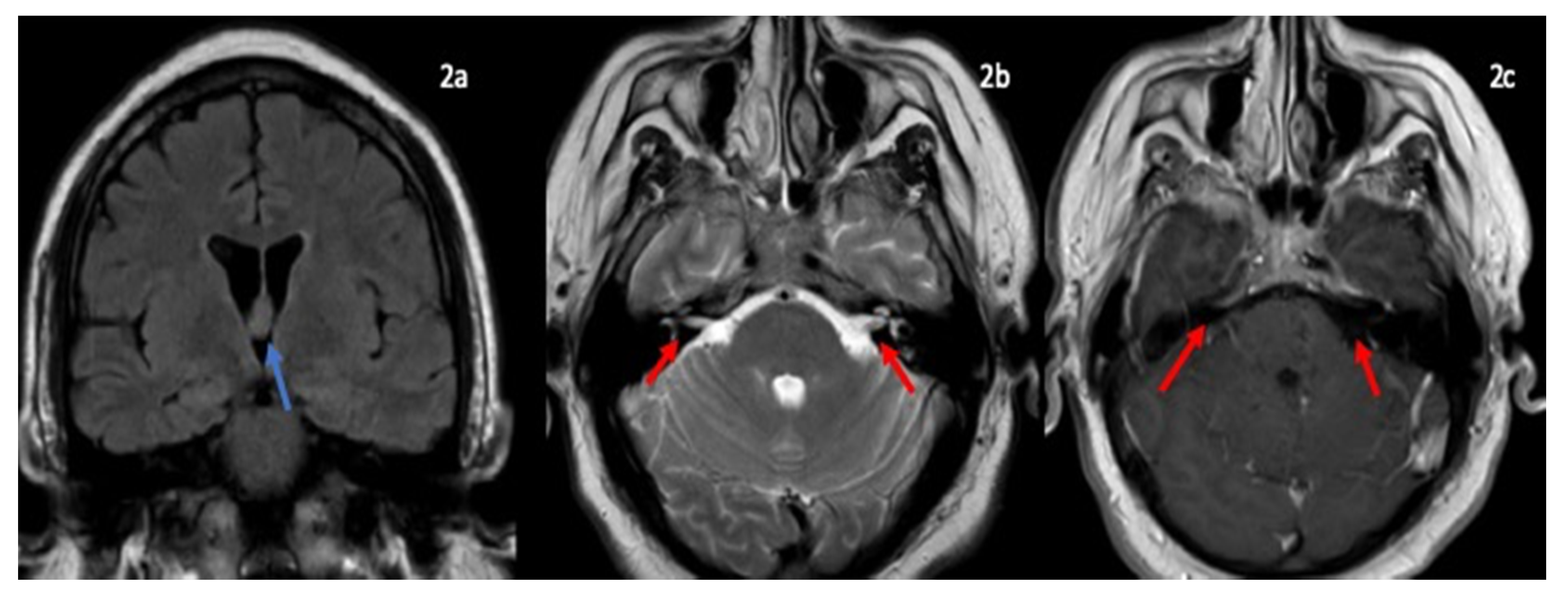 Neurology International Free Full Text A Novel Case Of Bifacial Diplegia Variant Of Guillain Barre Syndrome Following Janssen Covid 19 Vaccination Html