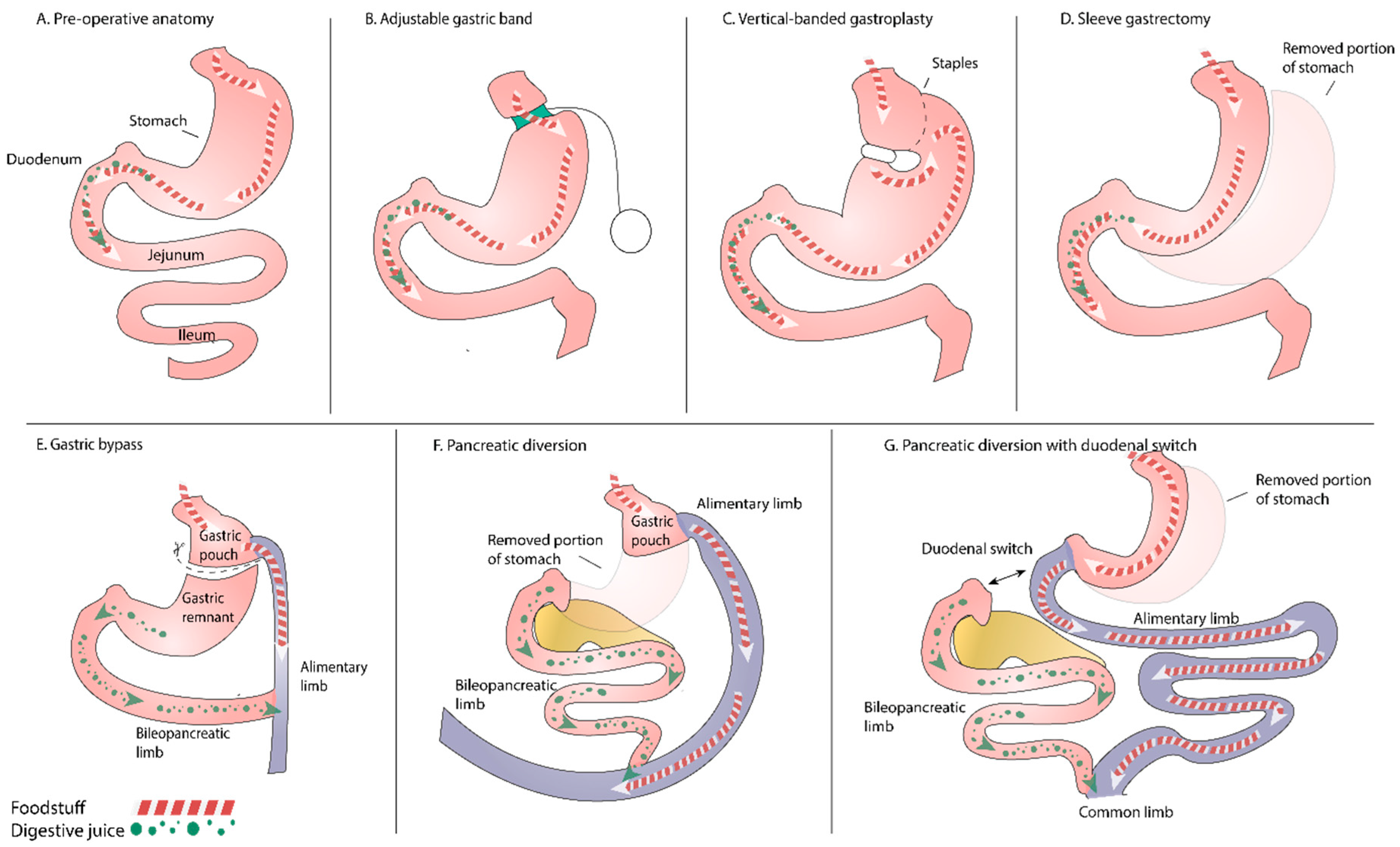 Nutrients | Free Full-Text | Pancreatic Exocrine Insufficiency after  Bariatric Surgery
