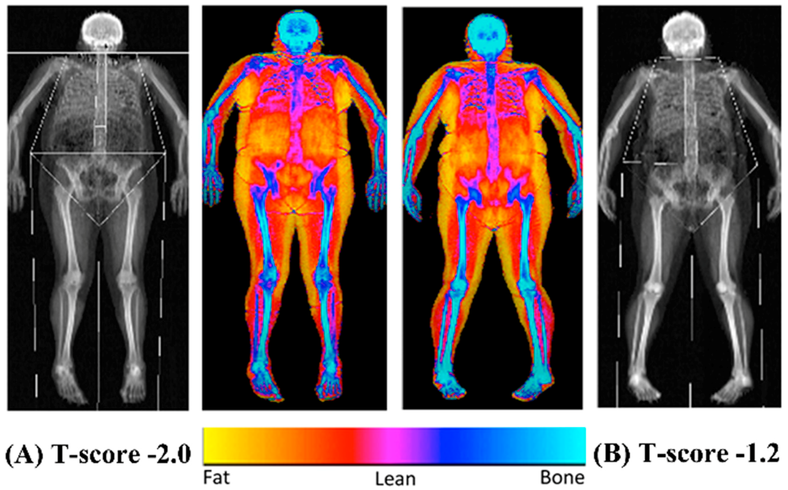 Nutrients | Free Full-Text | Body Fat Percentage, Body Mass Index, Fat Mass  Index and the Ageing Bone: Their Singular and Combined Roles Linked to  Physical Activity and Diet