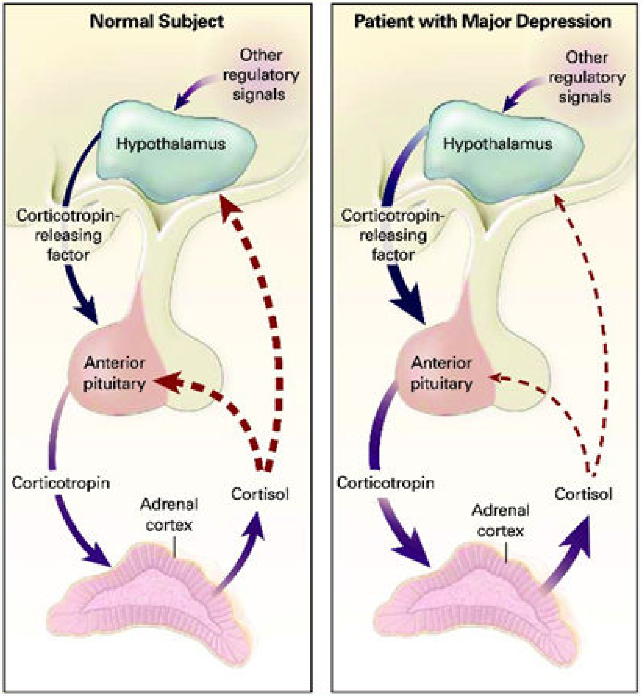 Hypothalamic Dysfunction