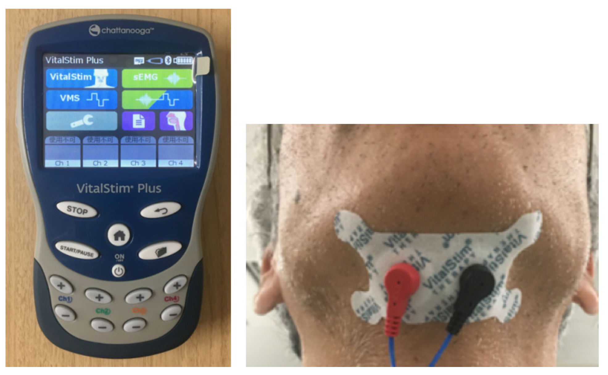 Treating Swallowing Disorders With Neuromuscular Electrical Stimulation