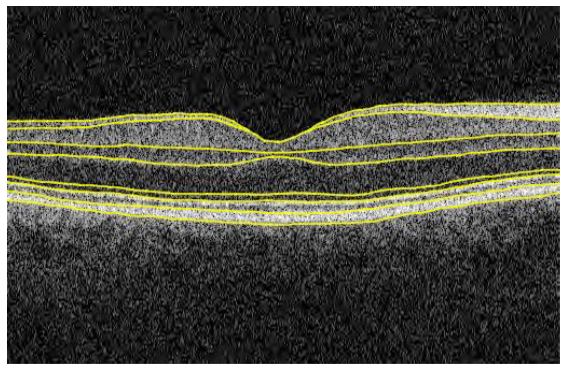 Study links drinking coffee and tea to increased macular retinal nerve  fiber layer thickness