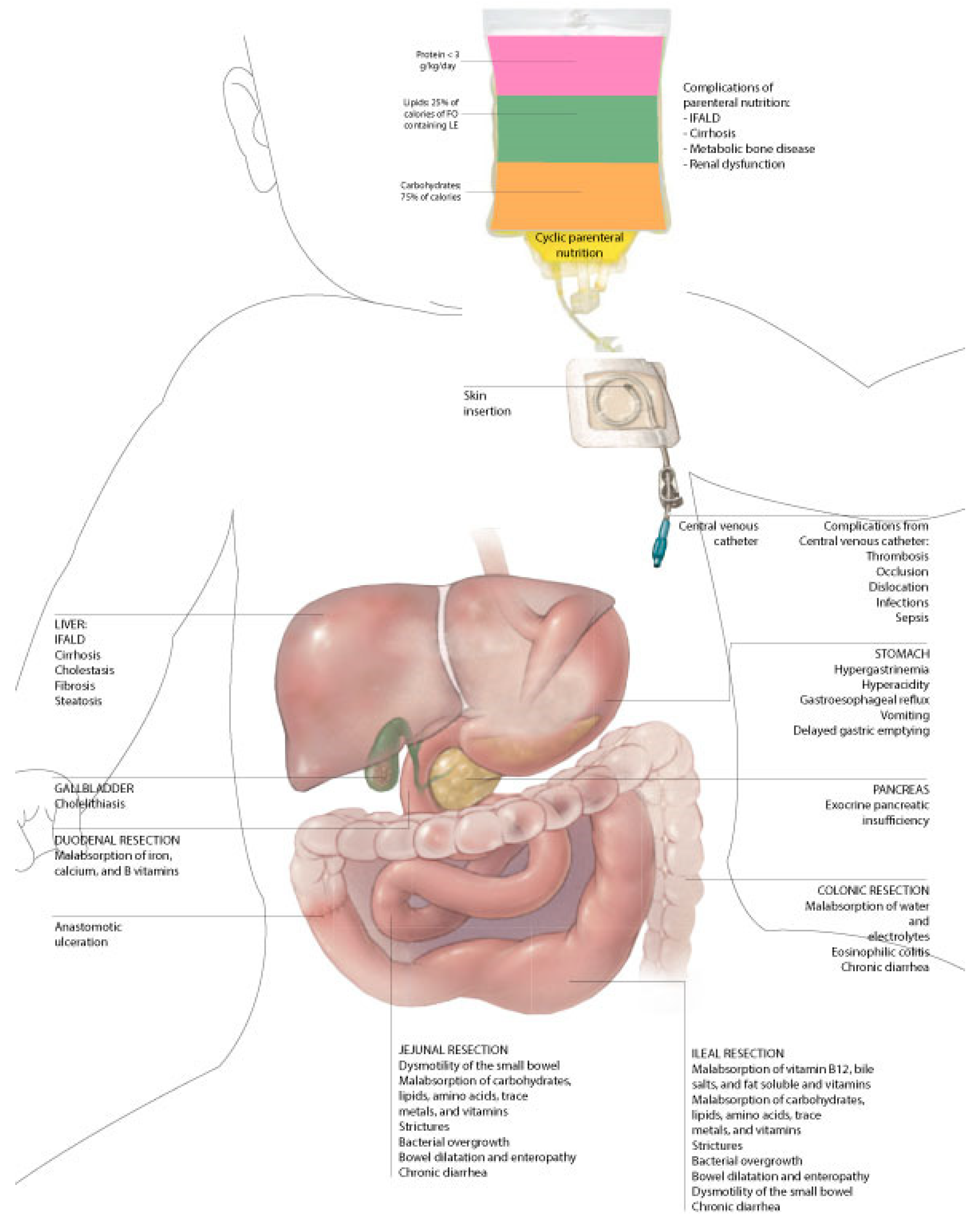 Nutrients | Free Full-Text | An Overview of Short-Bowel Syndrome in  Pediatric Patients: Focus on Clinical Management and Prevention of  Complications