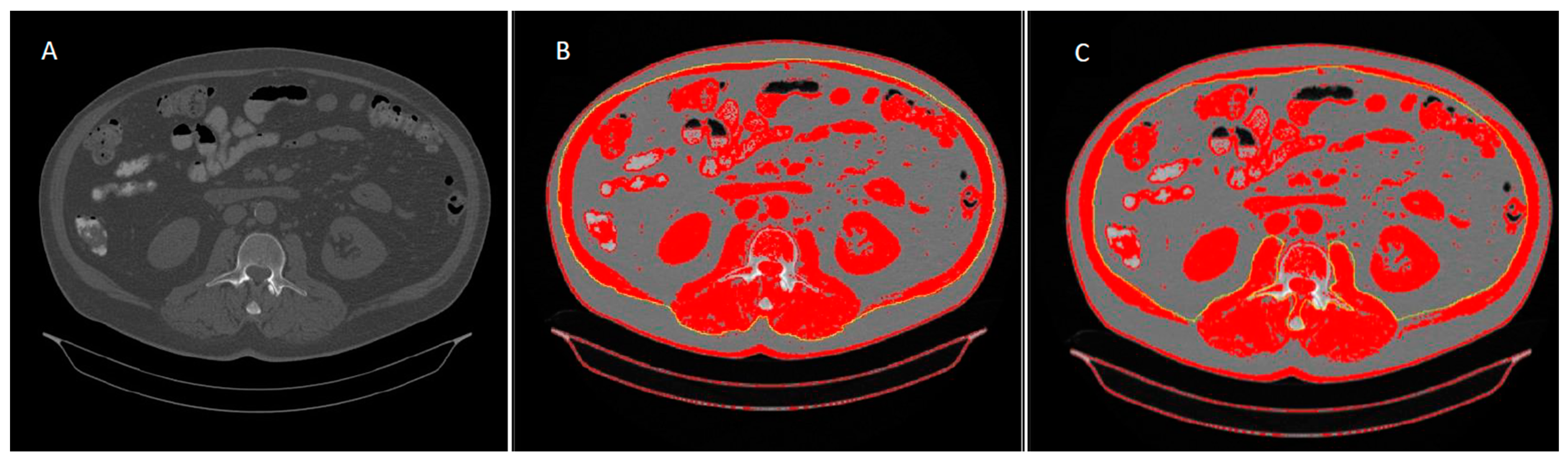 Nutrients | Free Full-Text | Detection of Sarcopenia in Patients with Liver  Cirrhosis Using the Bioelectrical Impedance Analysis