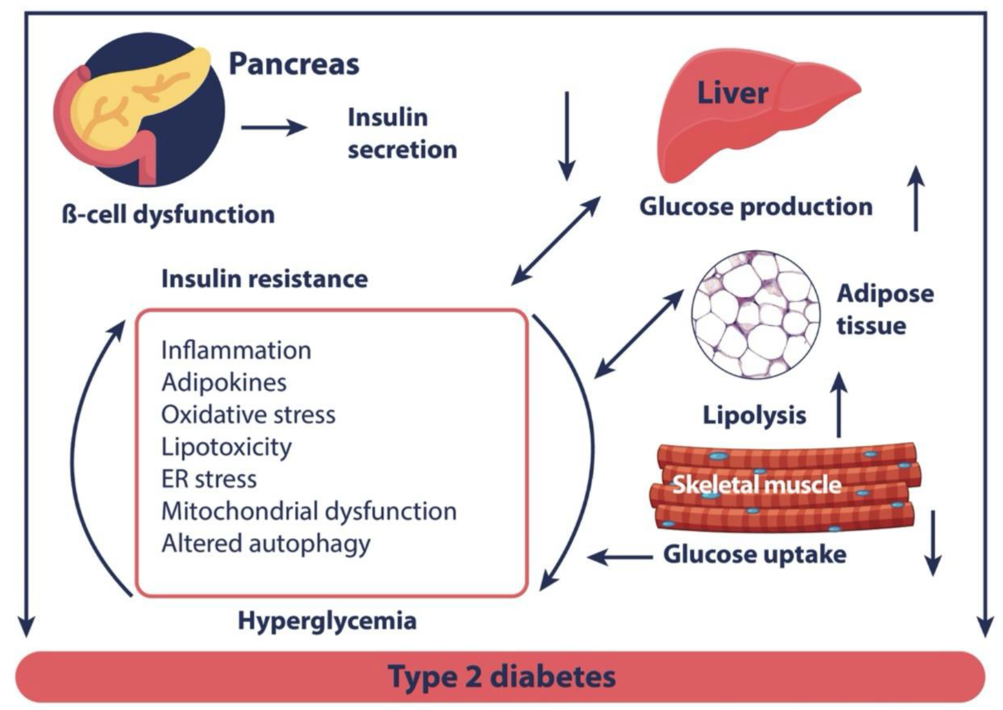 Sarcopenia as a Little Recognized Comorbidity of Type II Diabetes ...