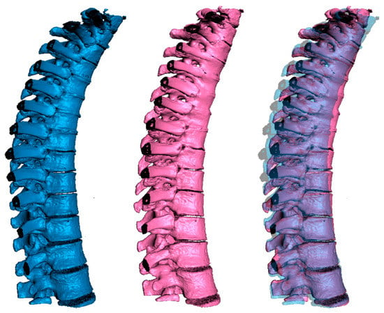 Association between ribs shape and pulmonary function in patients