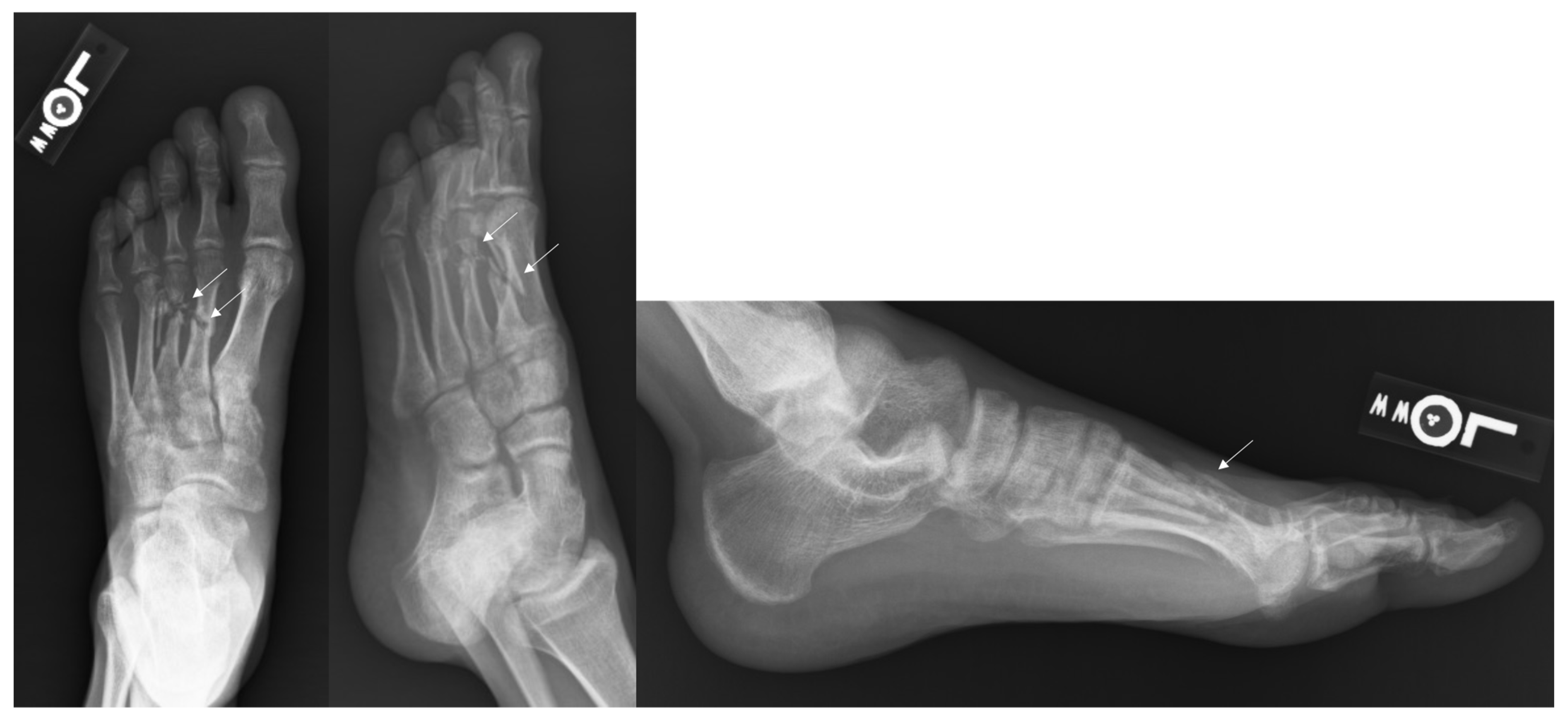 metatarsal fracture cast