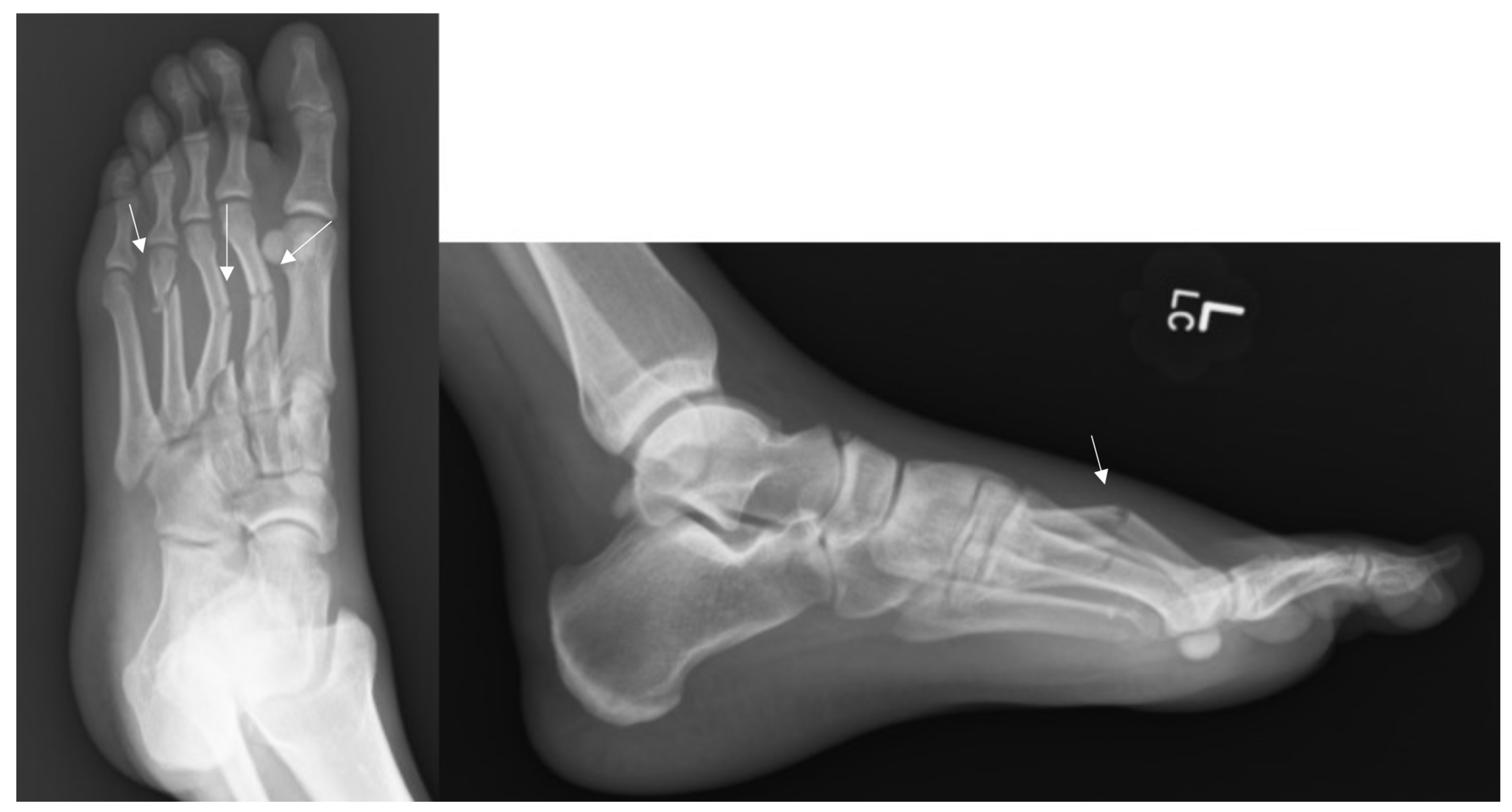 Osteology Free FullText Traumatic Lesser Metatarsal Fractures A