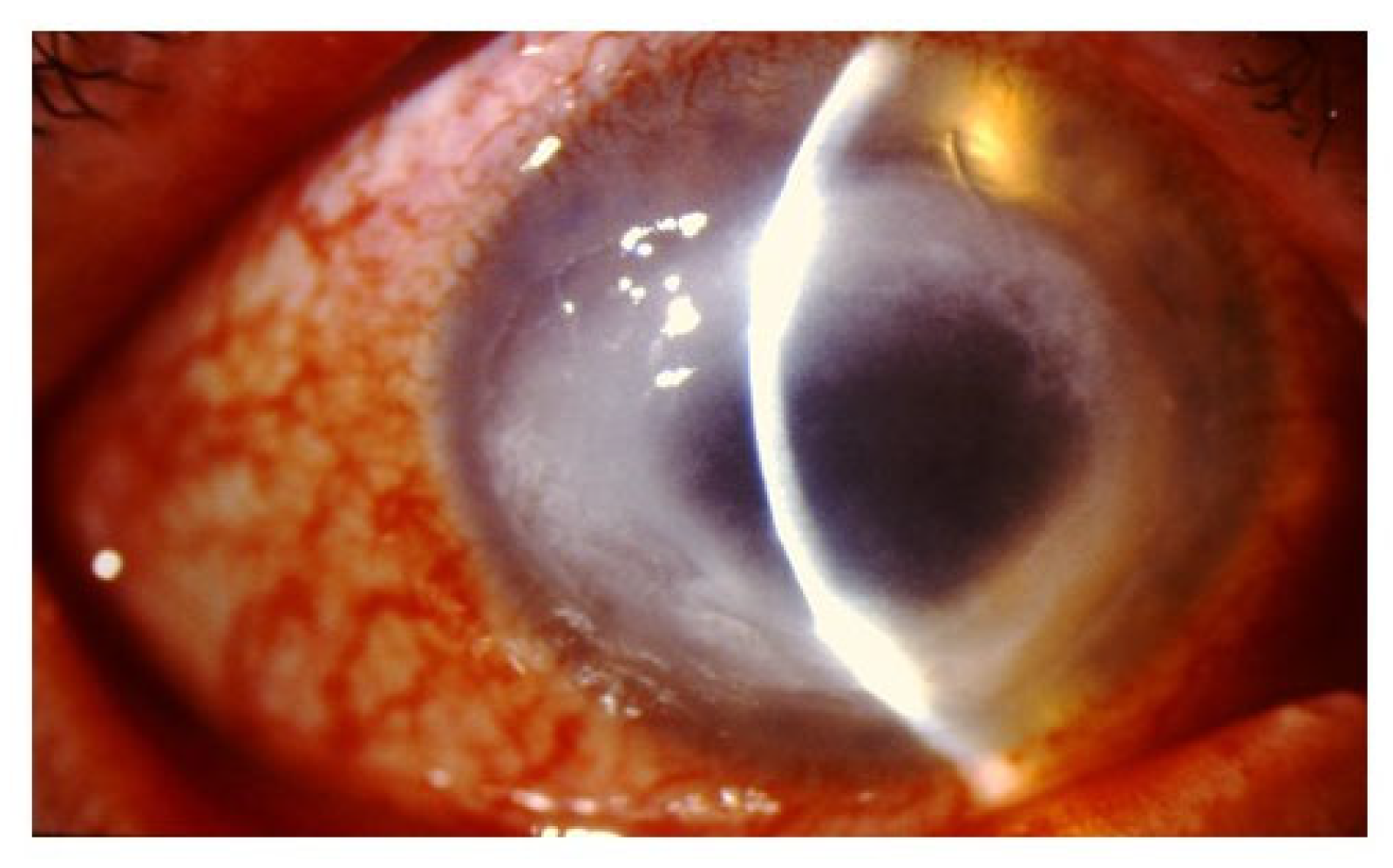 acanthamoeba corneal ulcer