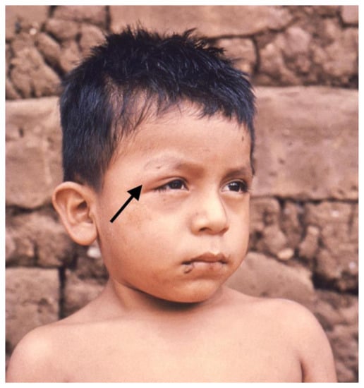 Pathogens Free Full Text Chagas Cardiomyopathy From Roma a