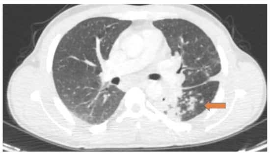 Pulmonary nodules in African migrants caused by chronic