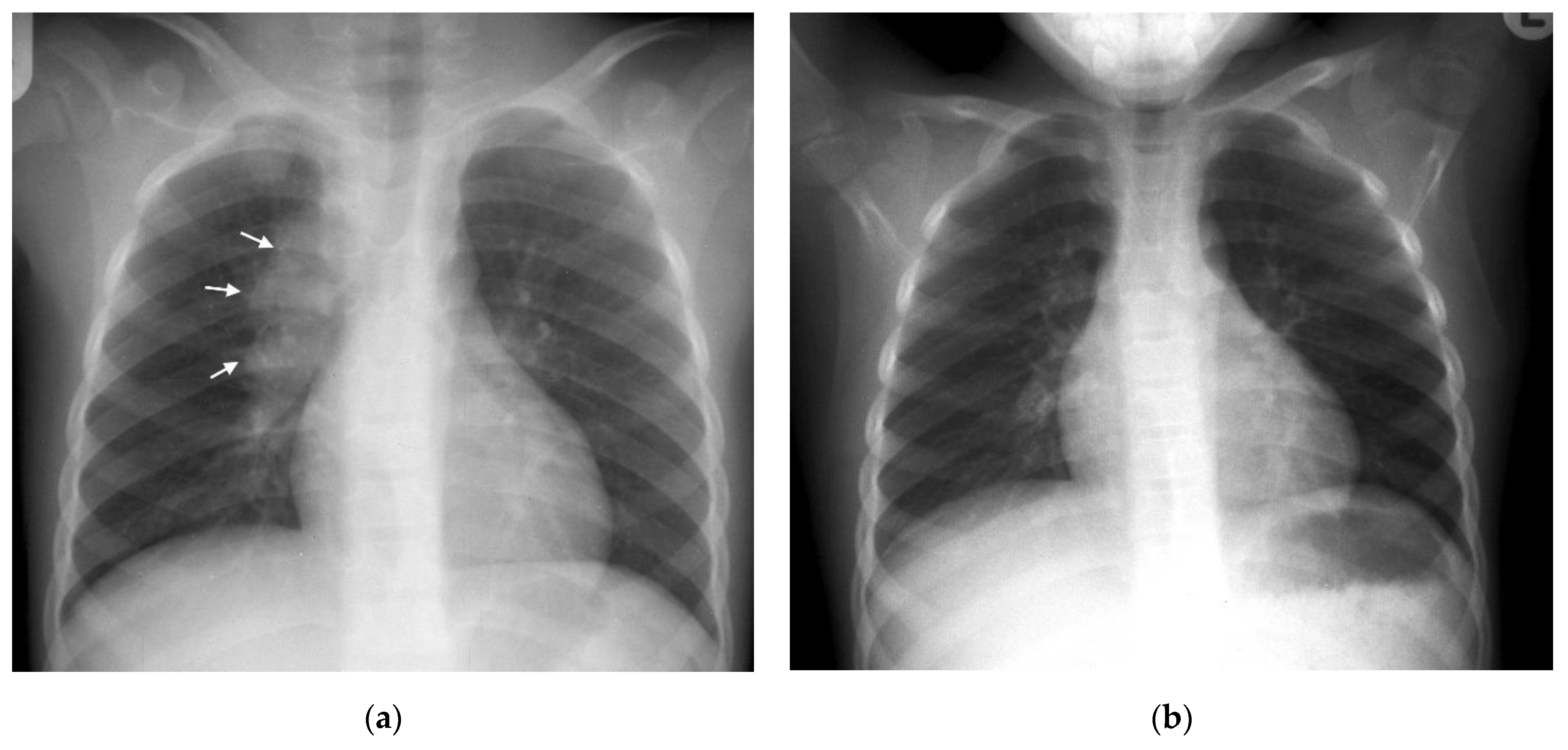 Pathogens | Free Full-Text | Chest Imaging for Pulmonary TB&mdash;An Update
