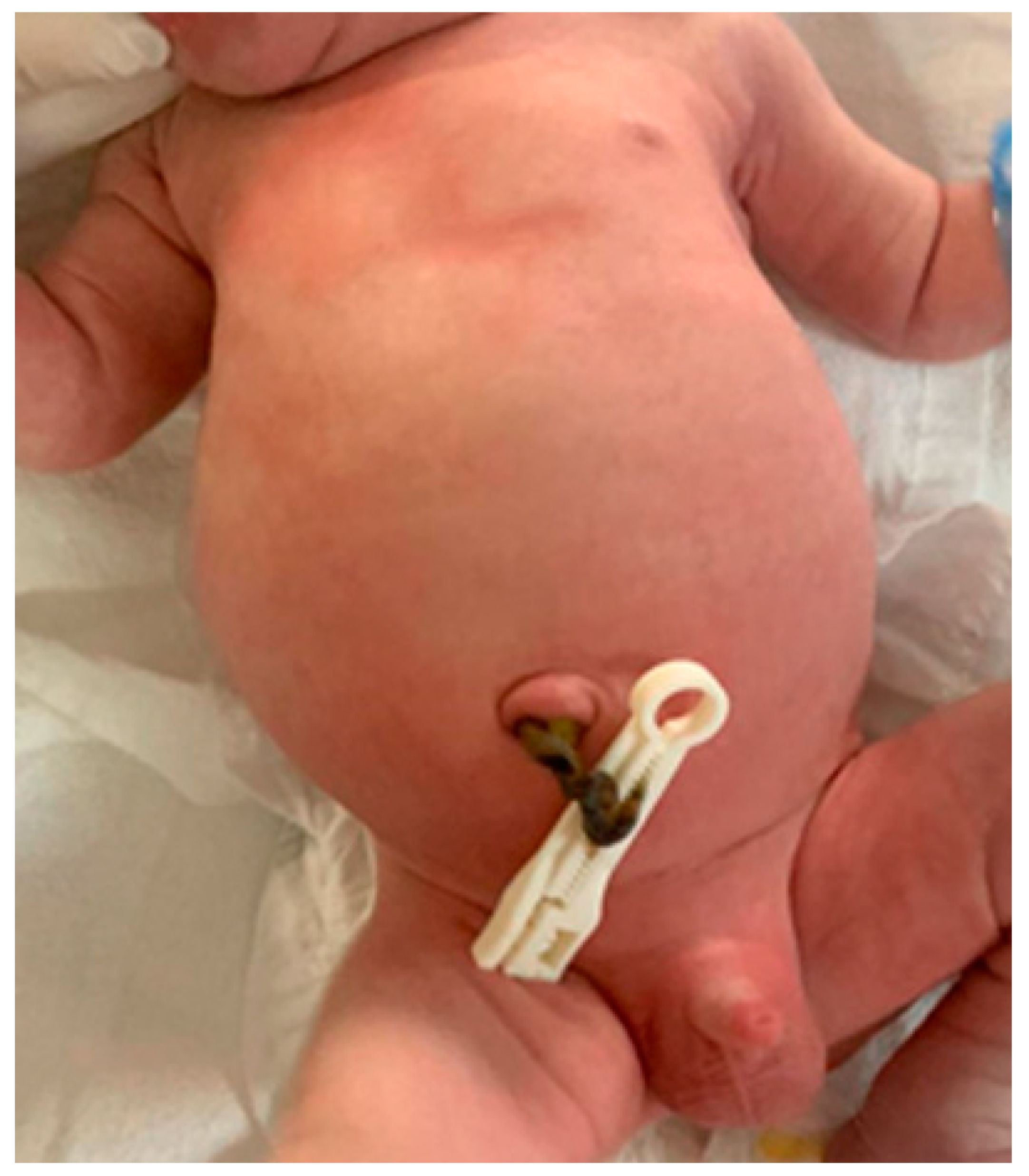 Icterus, ascites, and umbilical hernia in a child with idiopathic