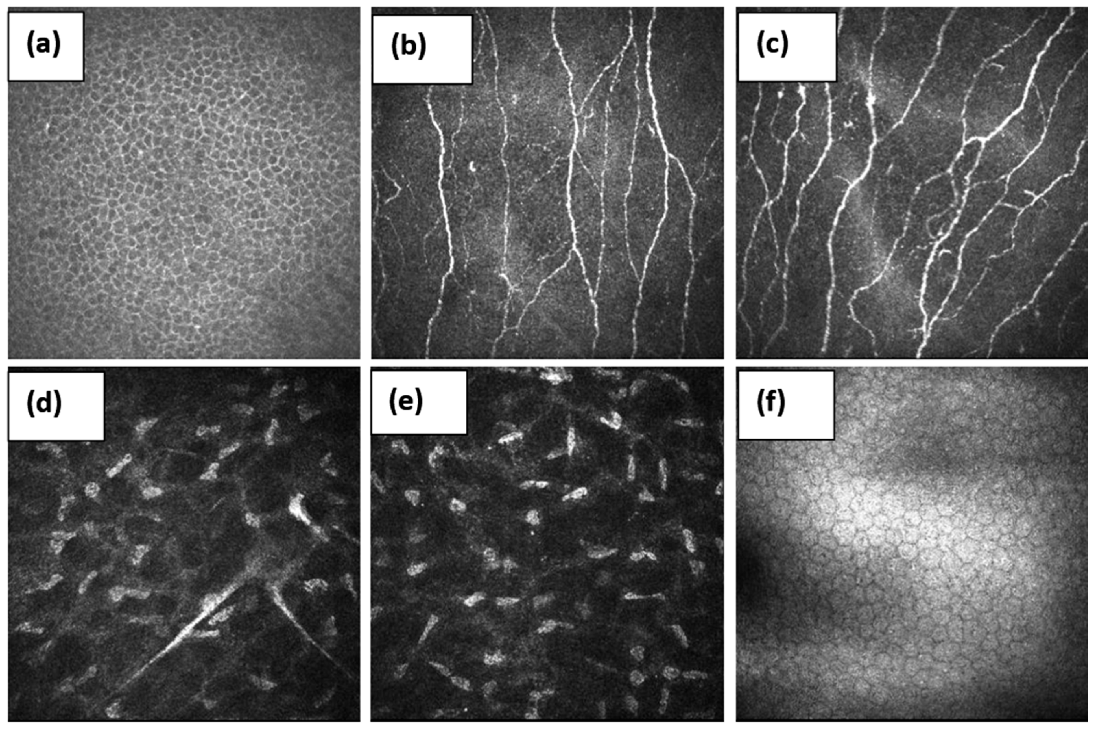 Pathophysiology | Free Full-Text | Corneal Confocal Microscopy in the  Diagnosis of Small Fiber Neuropathy: Faster, Easier, and More Efficient  Than Skin Biopsy? | HTML