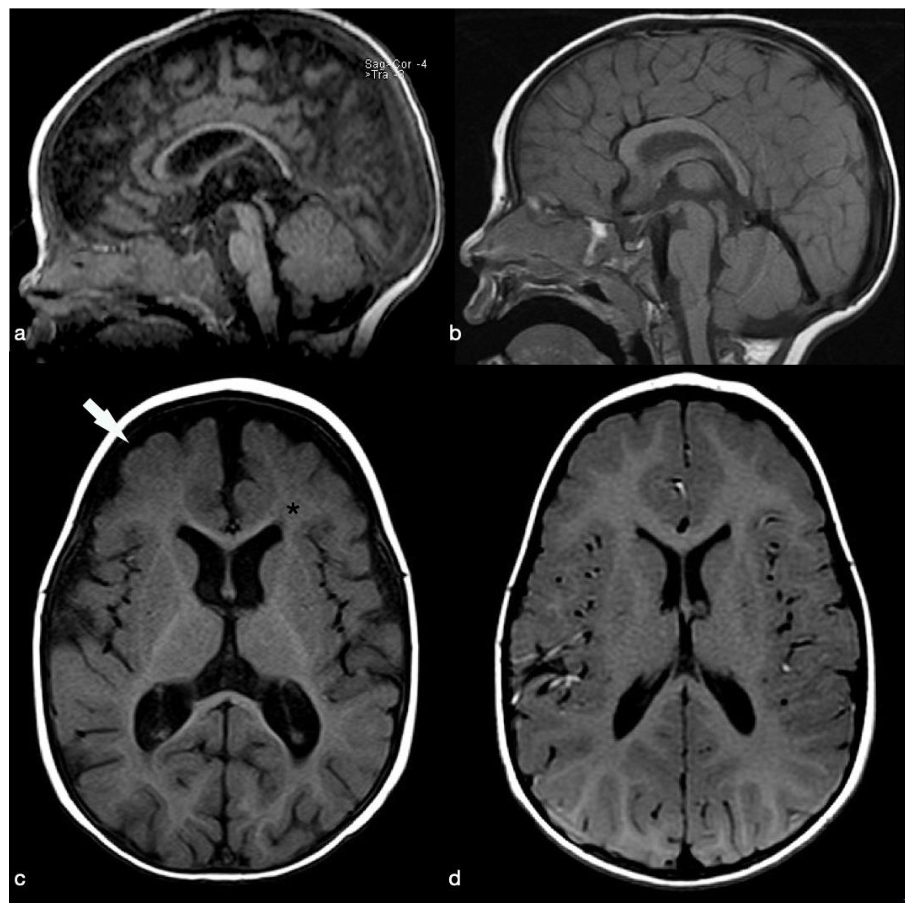 Pediatric Reports | Free Full-Text | Clinical and Brain Imaging Findings in  a Child with Vitamin B12 Deficiency
